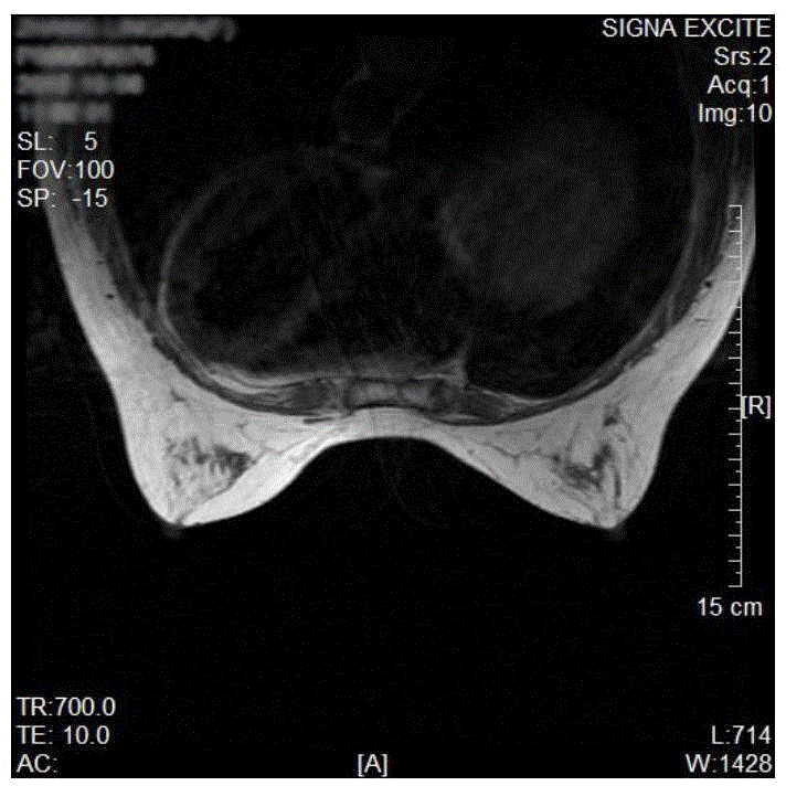 Method for establishing three-dimensional electromagnetic breast simulation model on basis of clinical MRI (magnetic resonance imaging) images