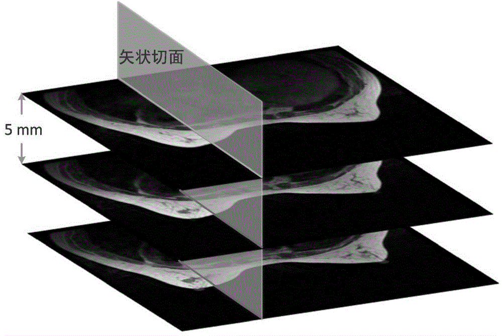 Method for establishing three-dimensional electromagnetic breast simulation model on basis of clinical MRI (magnetic resonance imaging) images