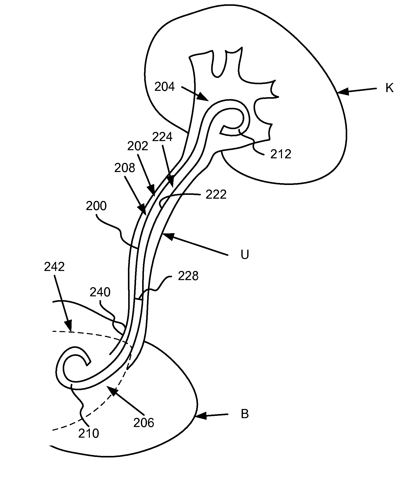 Stent with soluble bladder retention member