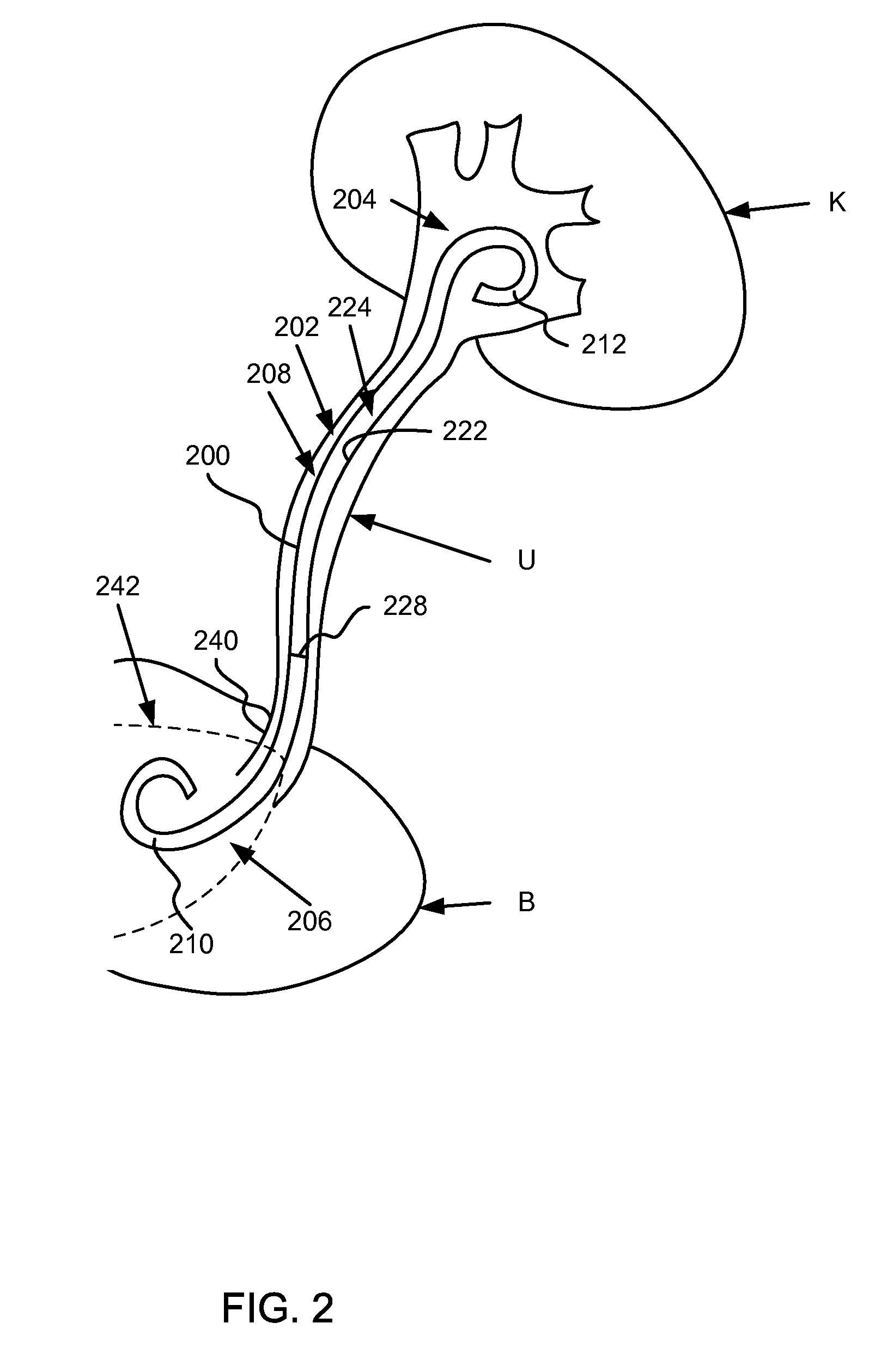 Stent with soluble bladder retention member