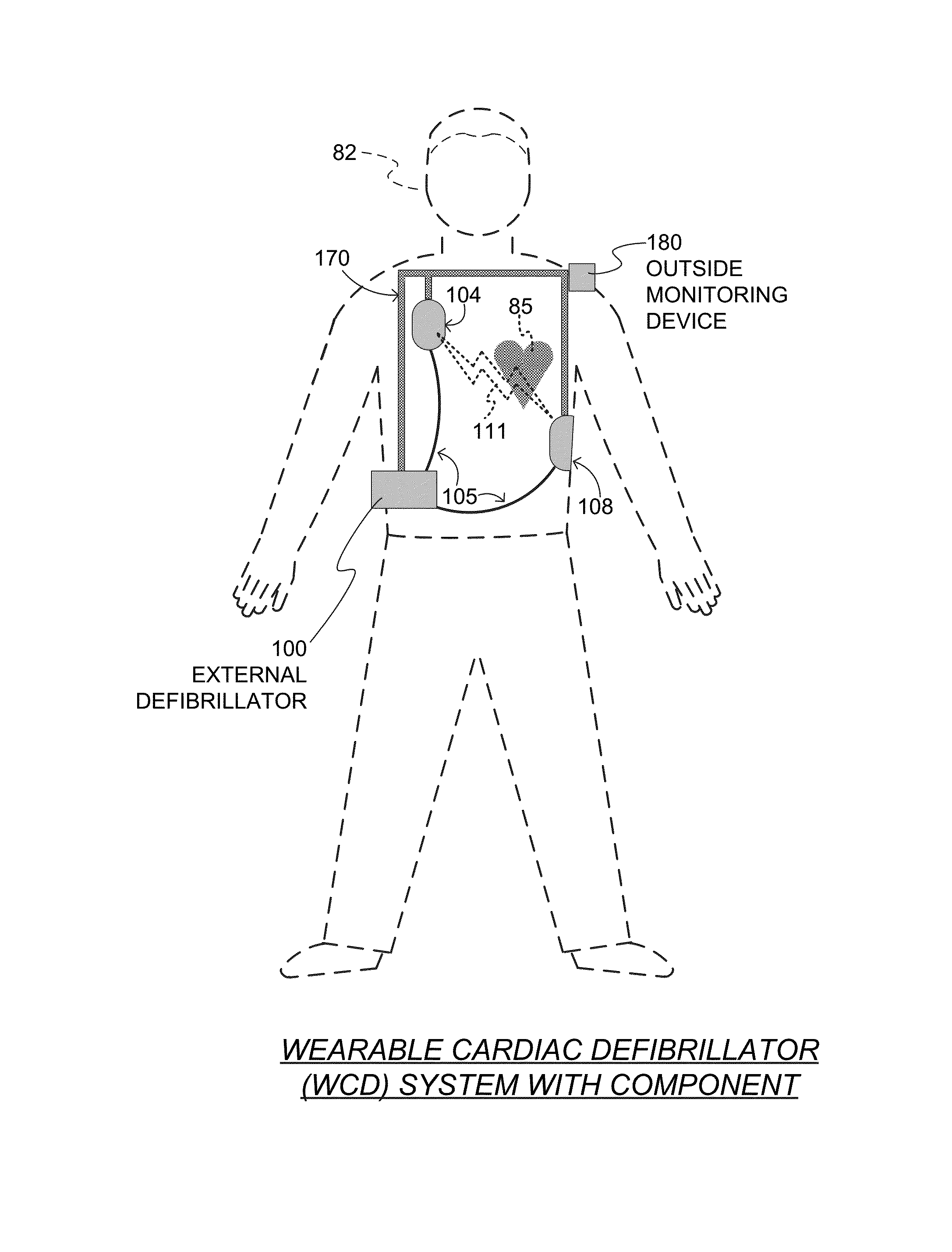 Wearable cardioverter defibrillator components discarding ECG signals prior to making shock/no shock determination