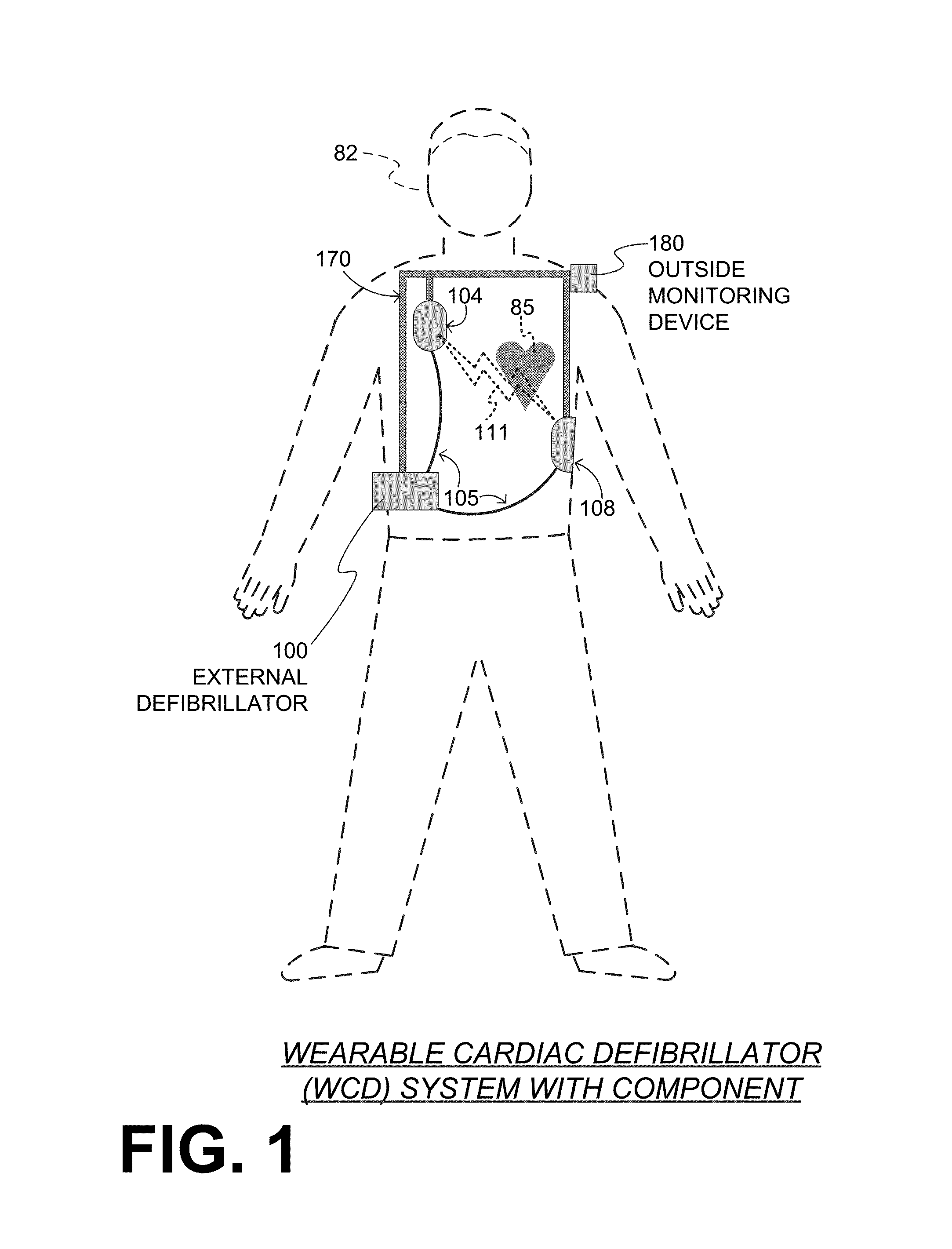 Wearable cardioverter defibrillator components discarding ECG signals prior to making shock/no shock determination