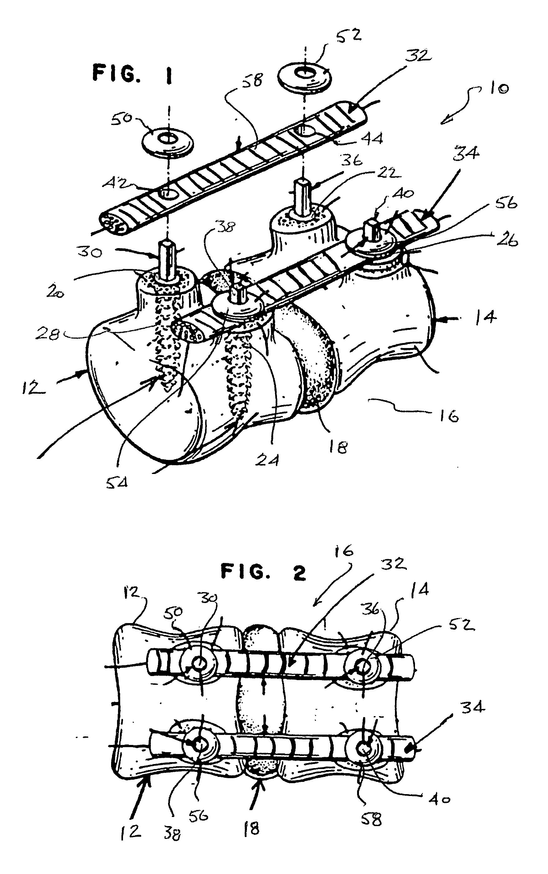 Dynamic spinal stabilization system