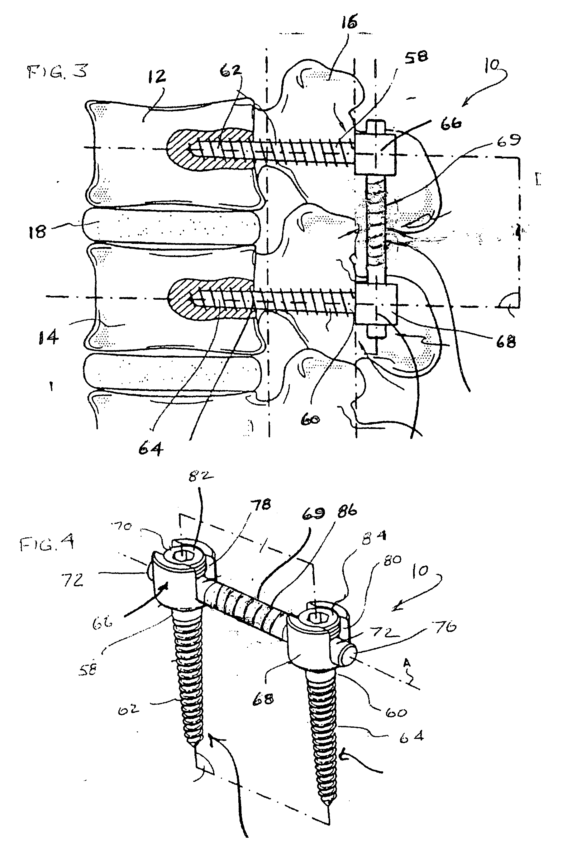 Dynamic spinal stabilization system