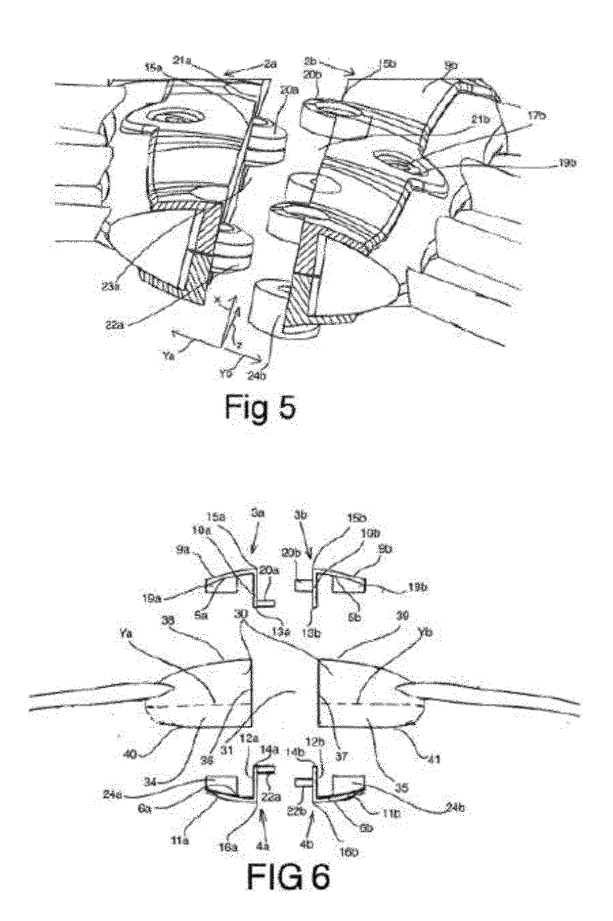 Split sternum prosthesis