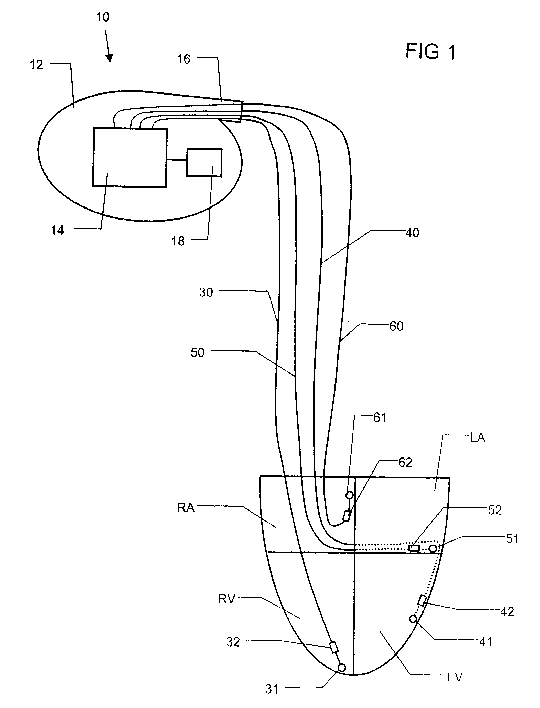 Systolic function monitoring utilizing slope of measured impedance