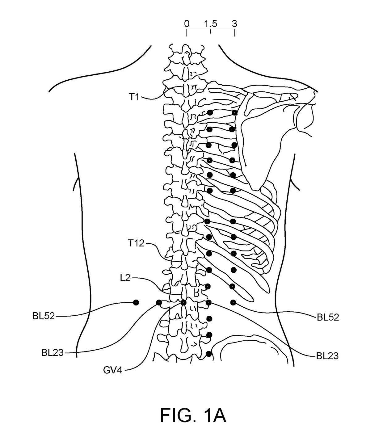 Methods and Systems for Treating a Chronic Low Back Pain Condition Using an Implantable Electroacupuncture Device