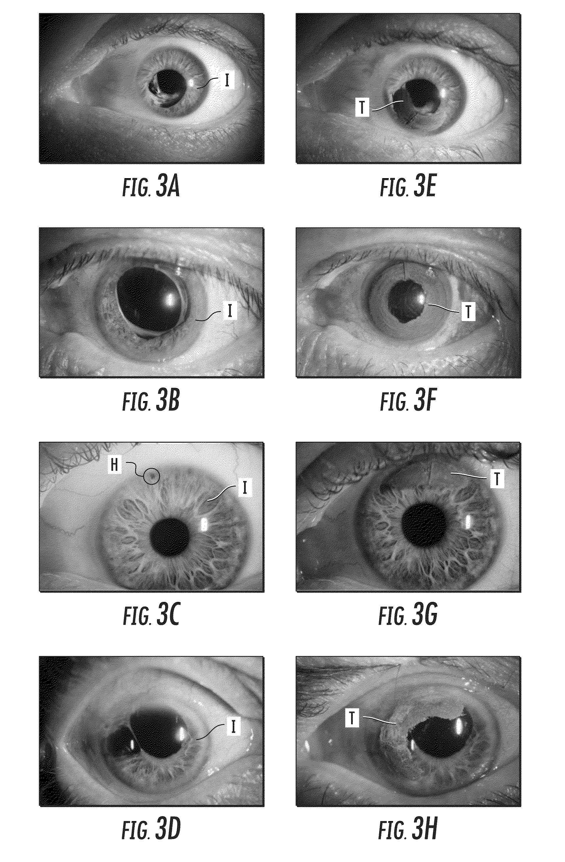 Surgical tools and systems for corneal tattooing and related methods