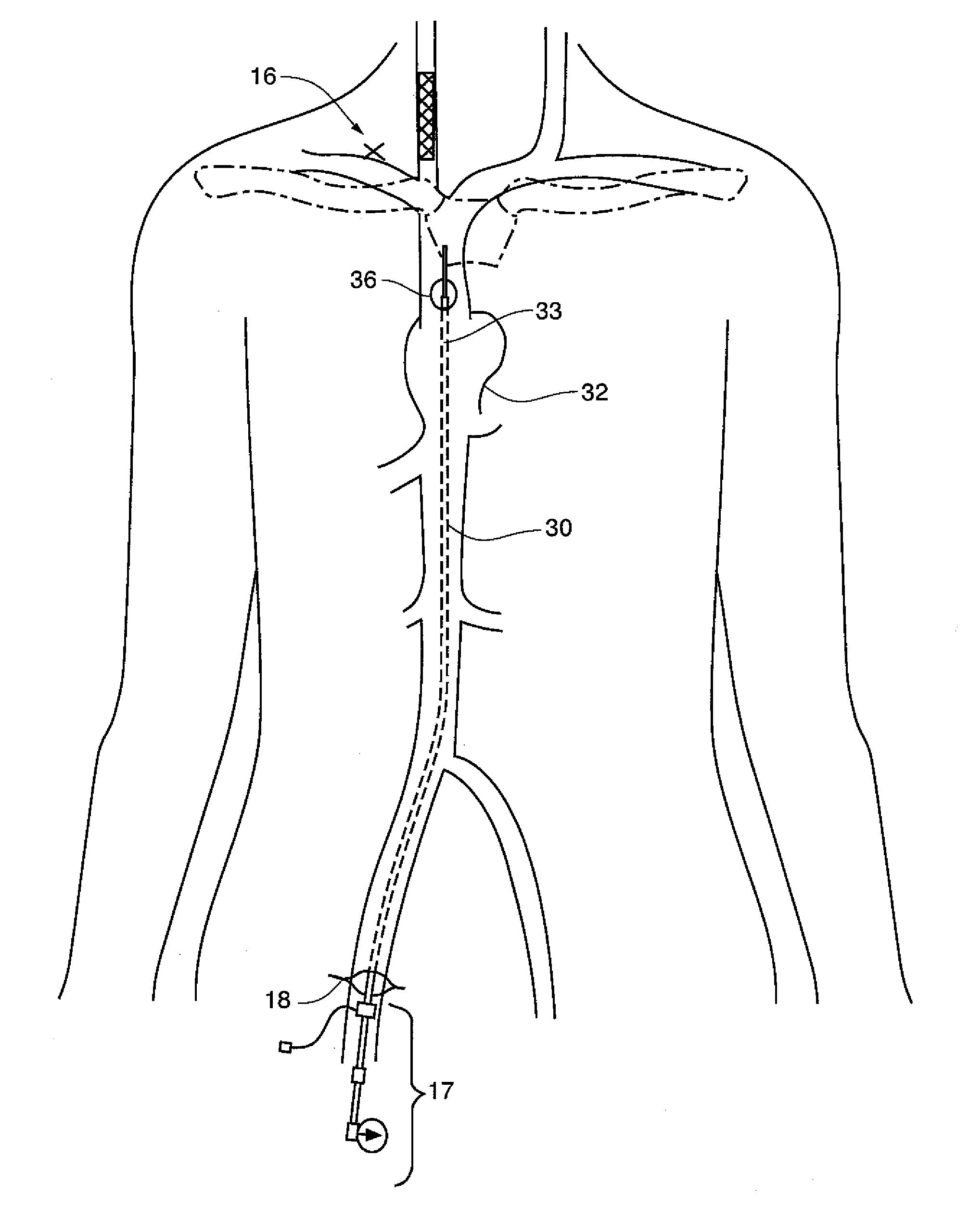 Central venous access system