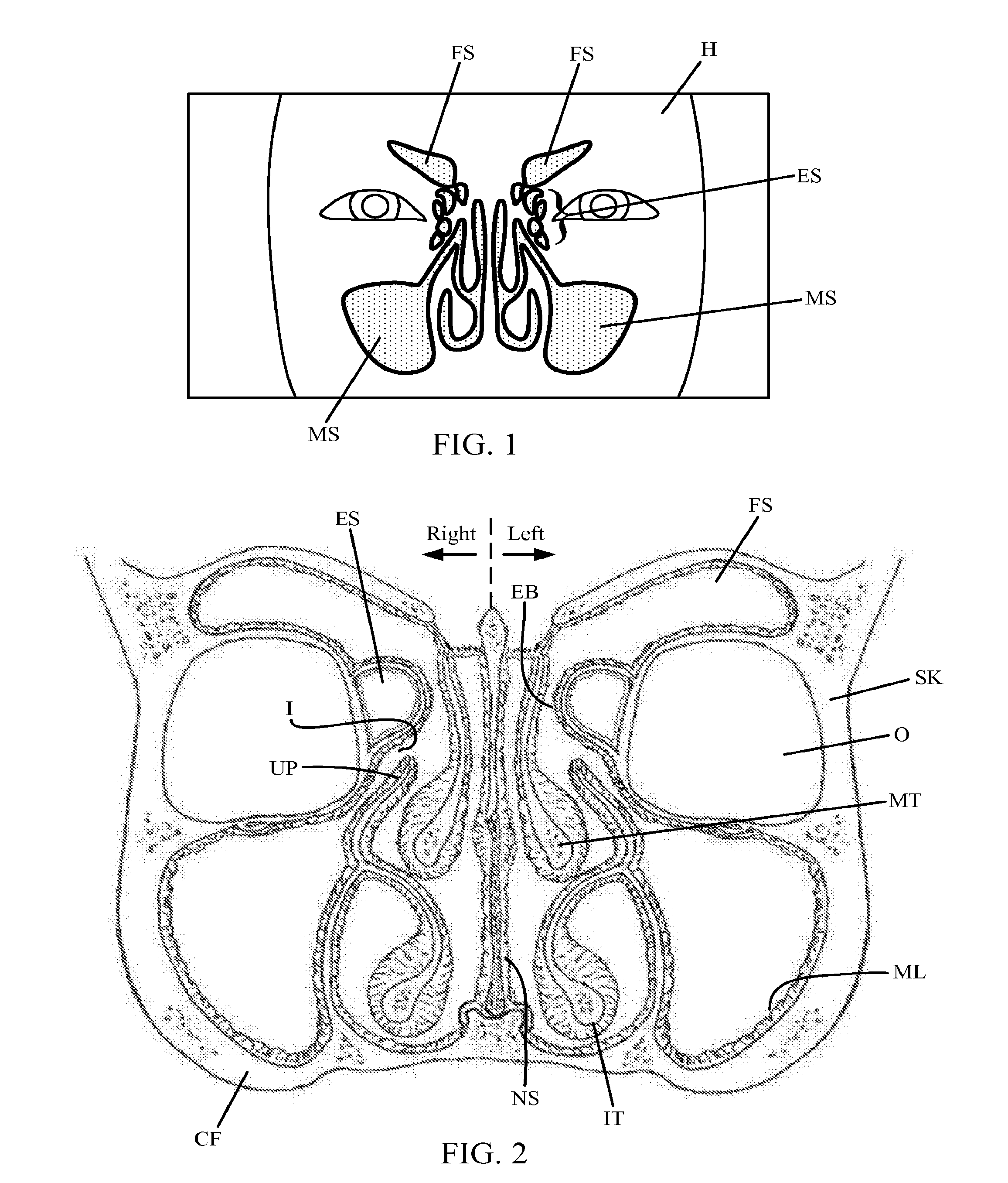 Guide catheter and method of use