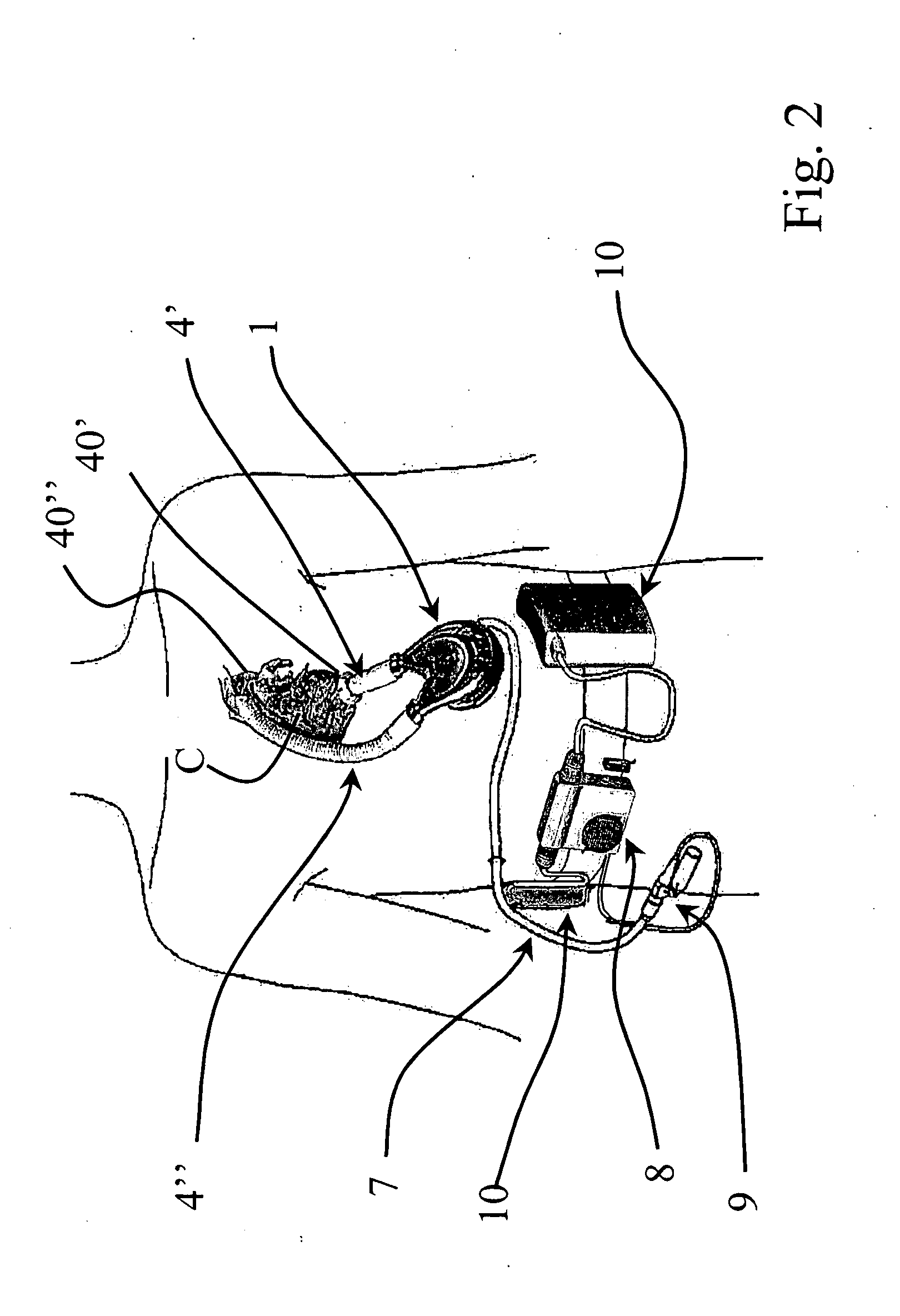 Ventricular assist device and related computer program product