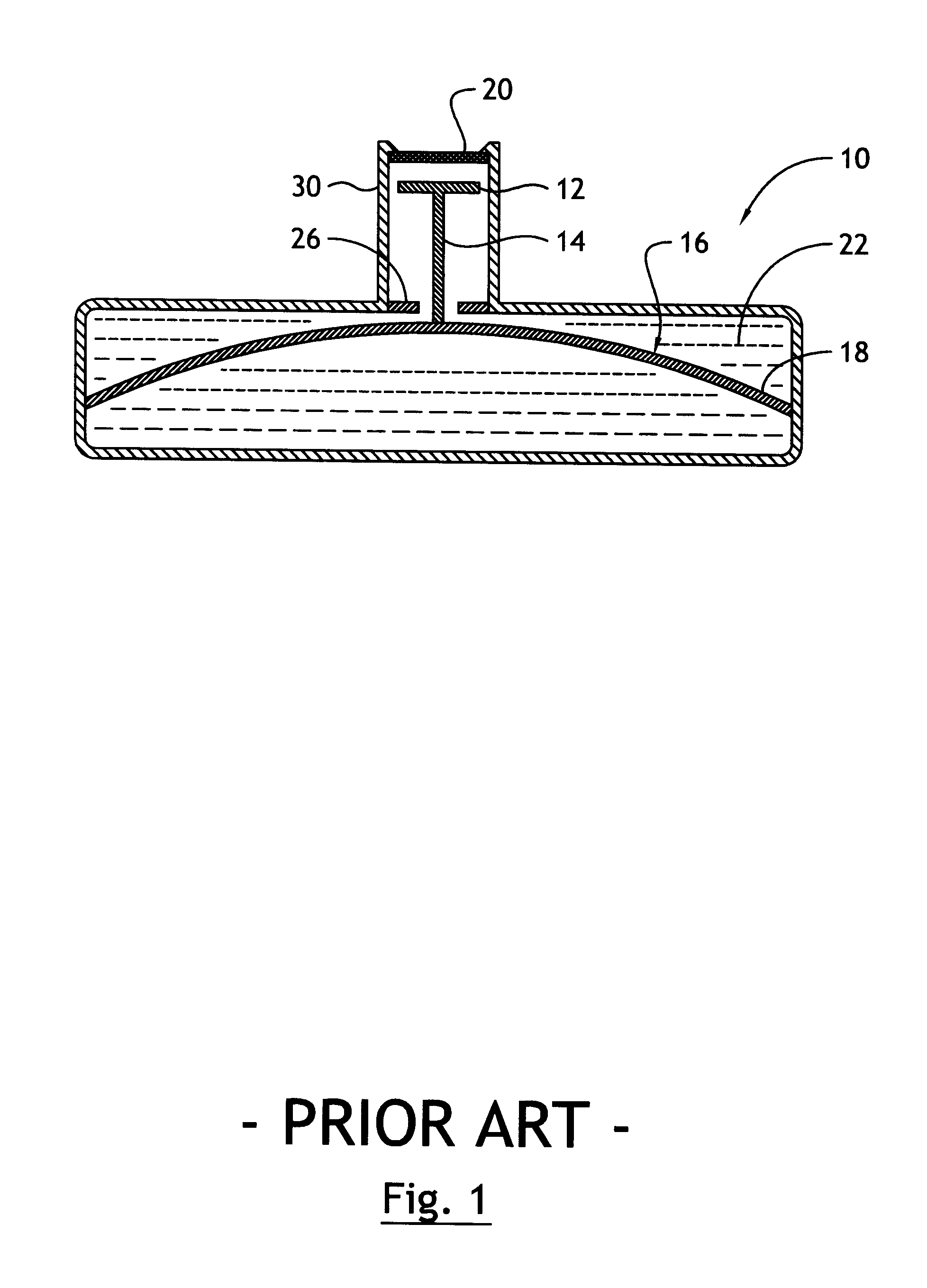 Overfill protection systems for implantable drug delivery devices