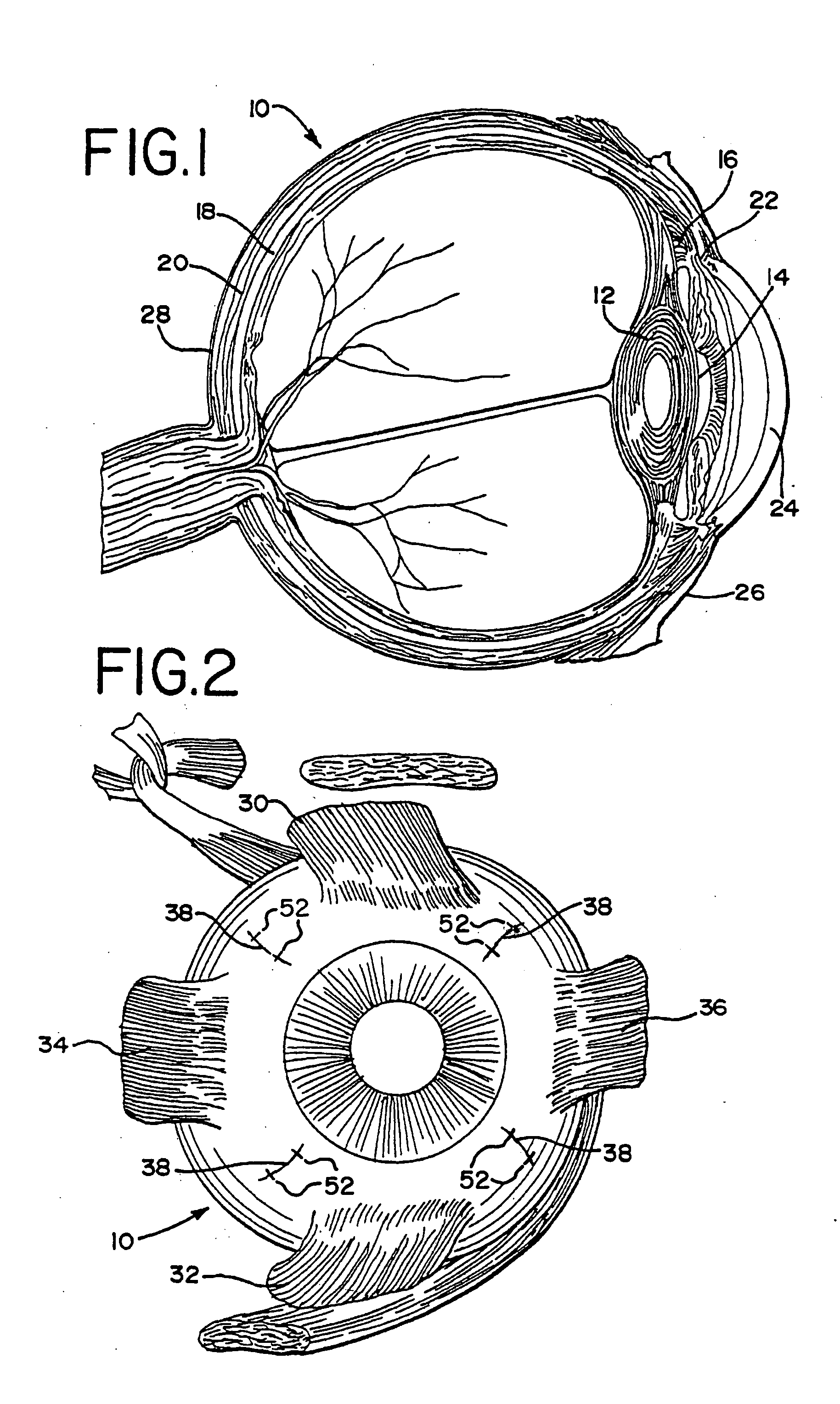 Ophthalmic clip and associated surgical method