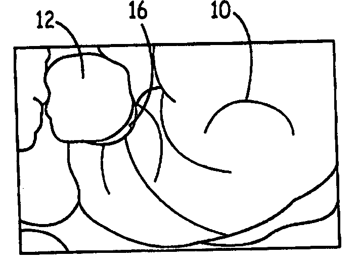 Methods and devices for occlusion of an atrial appendage