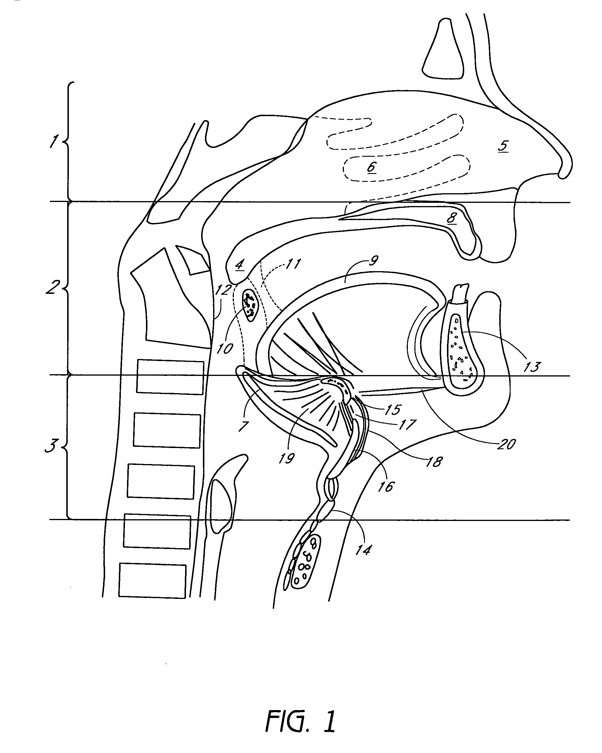 System and method for percutaneous glossoplasty