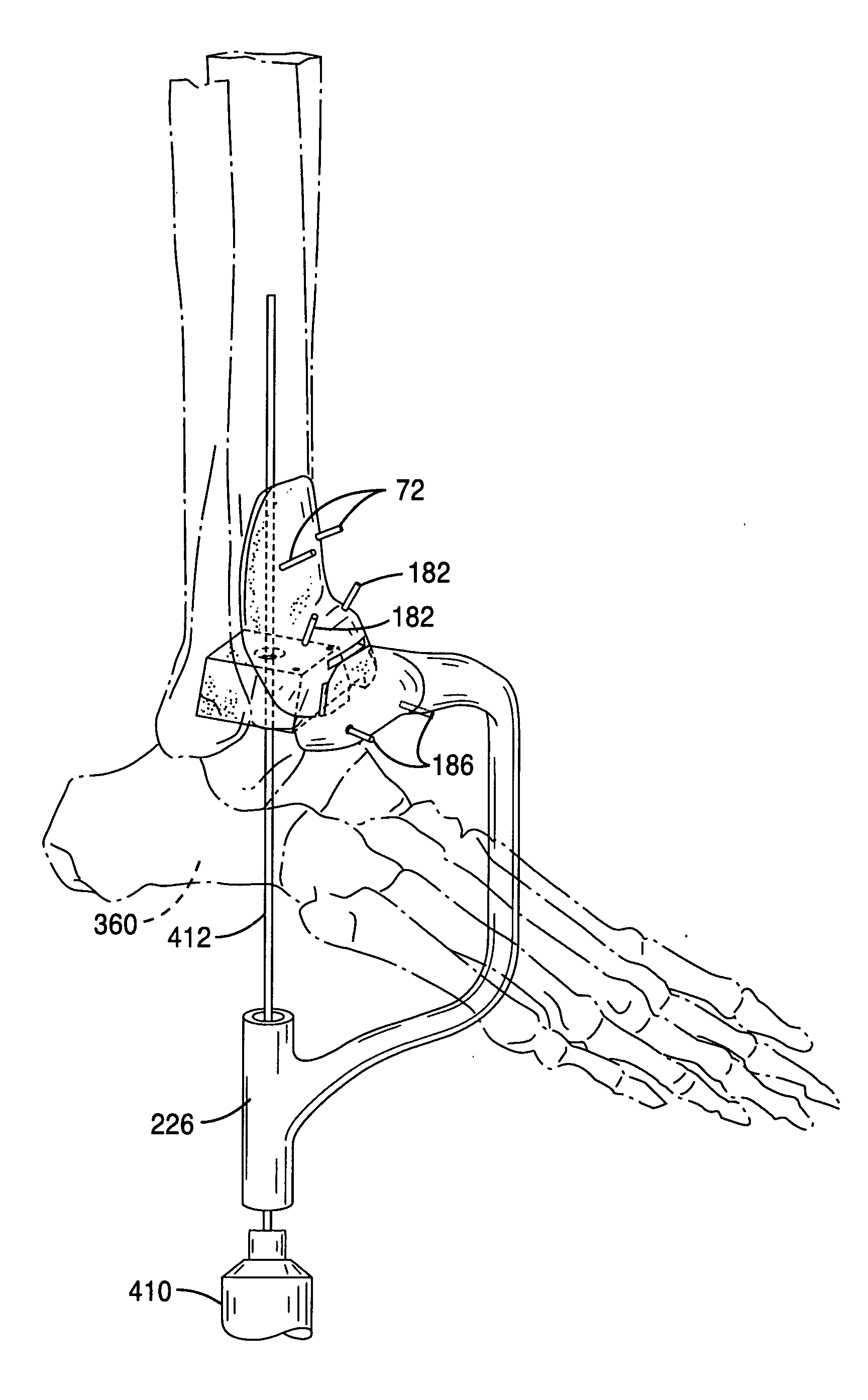 Systems and instrumentalities for use in total ankle replacement surgery