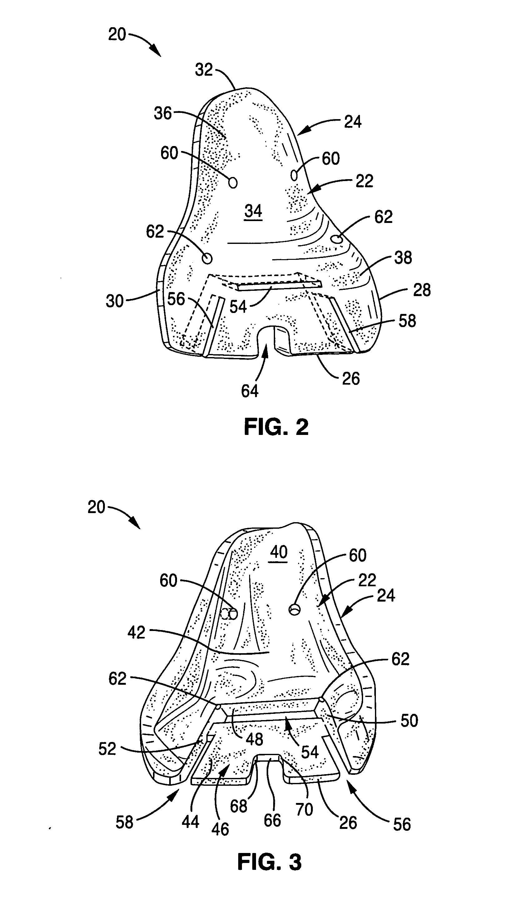 Systems and instrumentalities for use in total ankle replacement surgery