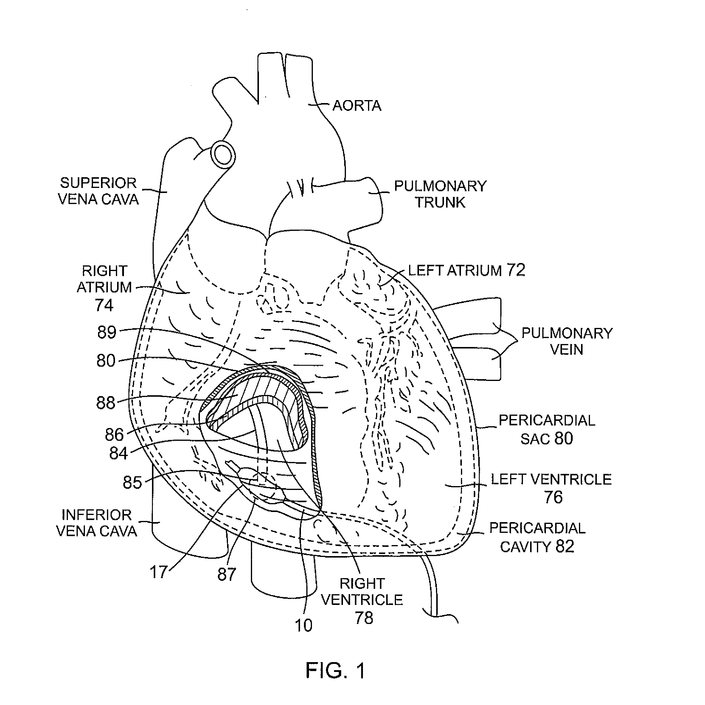 Pericardial catheter with temperature sensing array