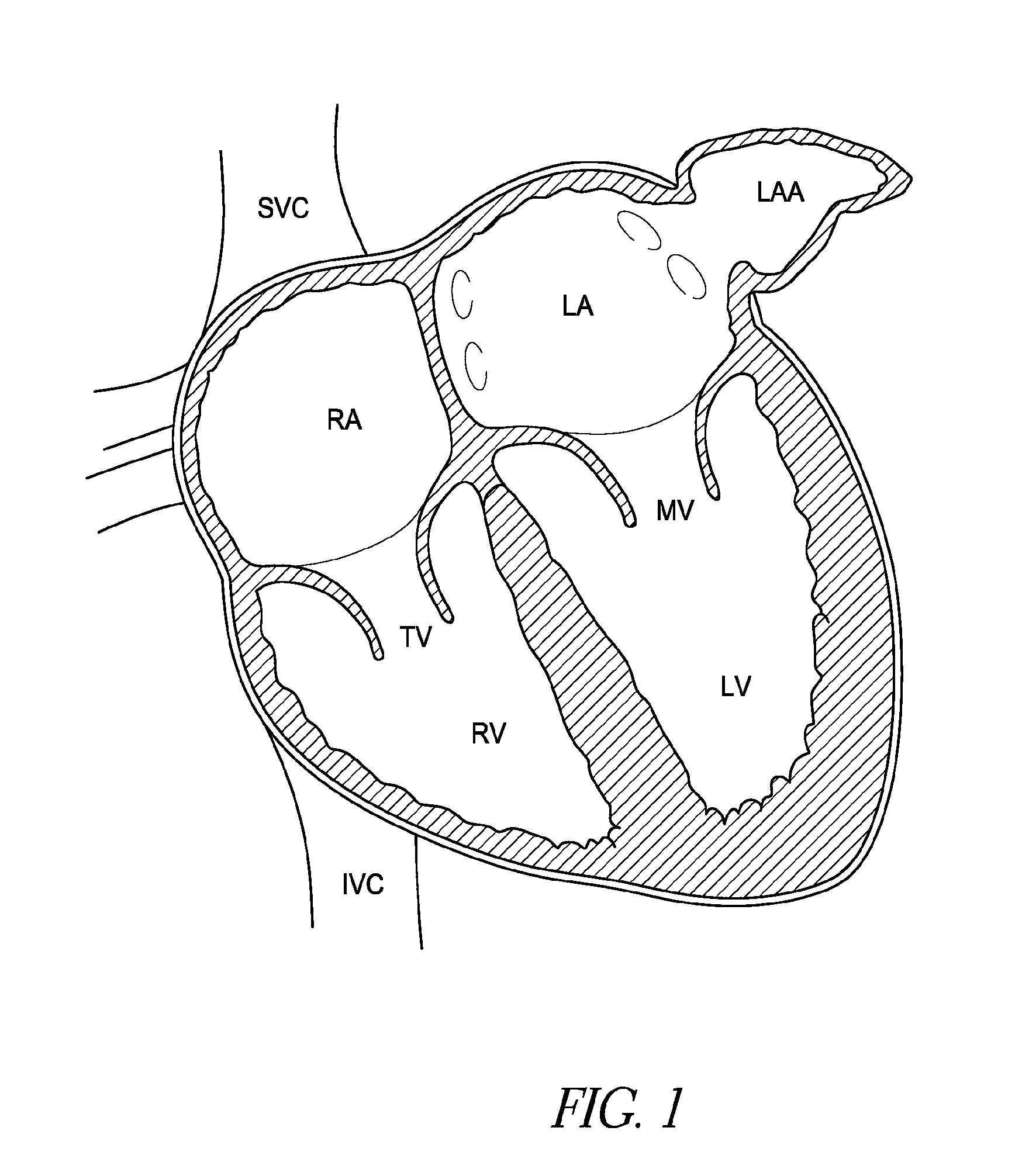 Left atrial appendage occlusion devices and methods