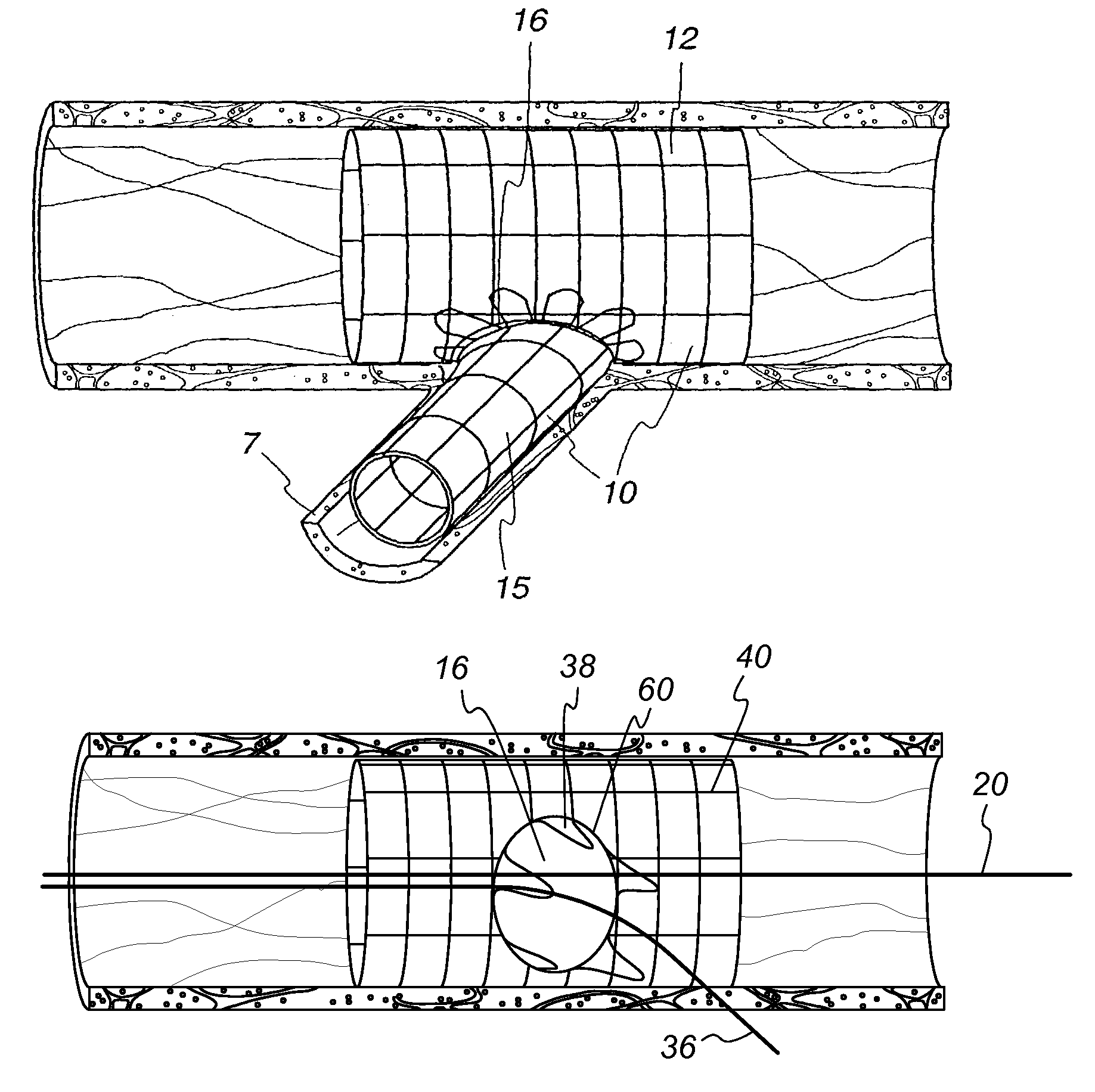 Extendible stent apparatus