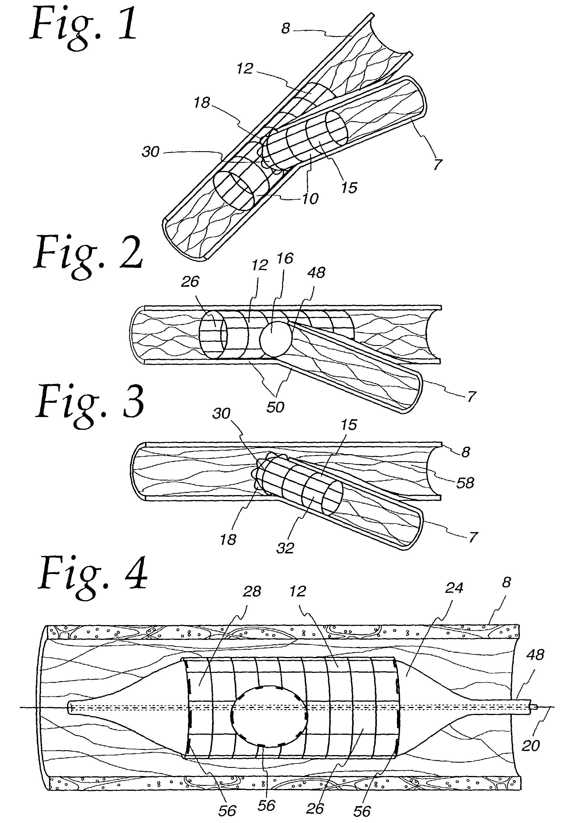 Extendible stent apparatus