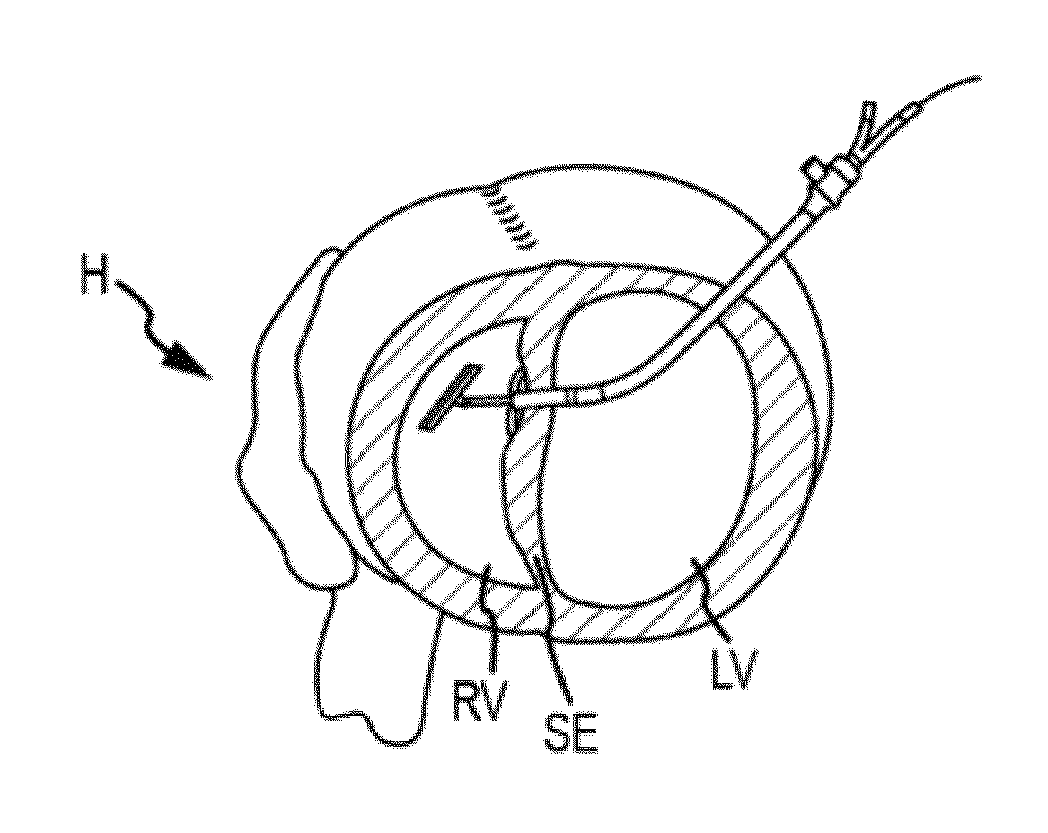 Trans-catheter ventricular reconstruction structures, methods, and systems for treatment of congestive heart failure and other conditions