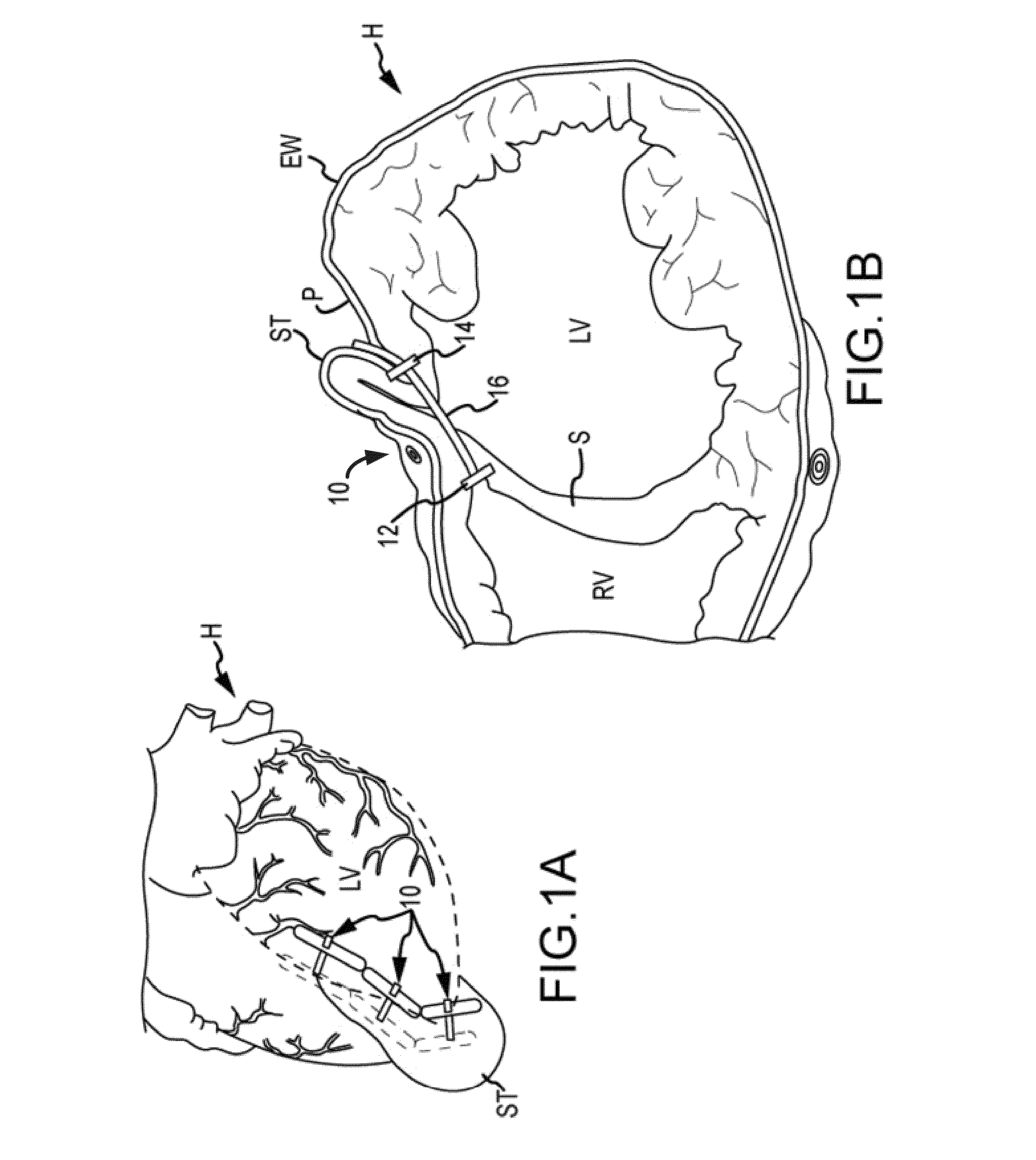 Trans-catheter ventricular reconstruction structures, methods, and systems for treatment of congestive heart failure and other conditions