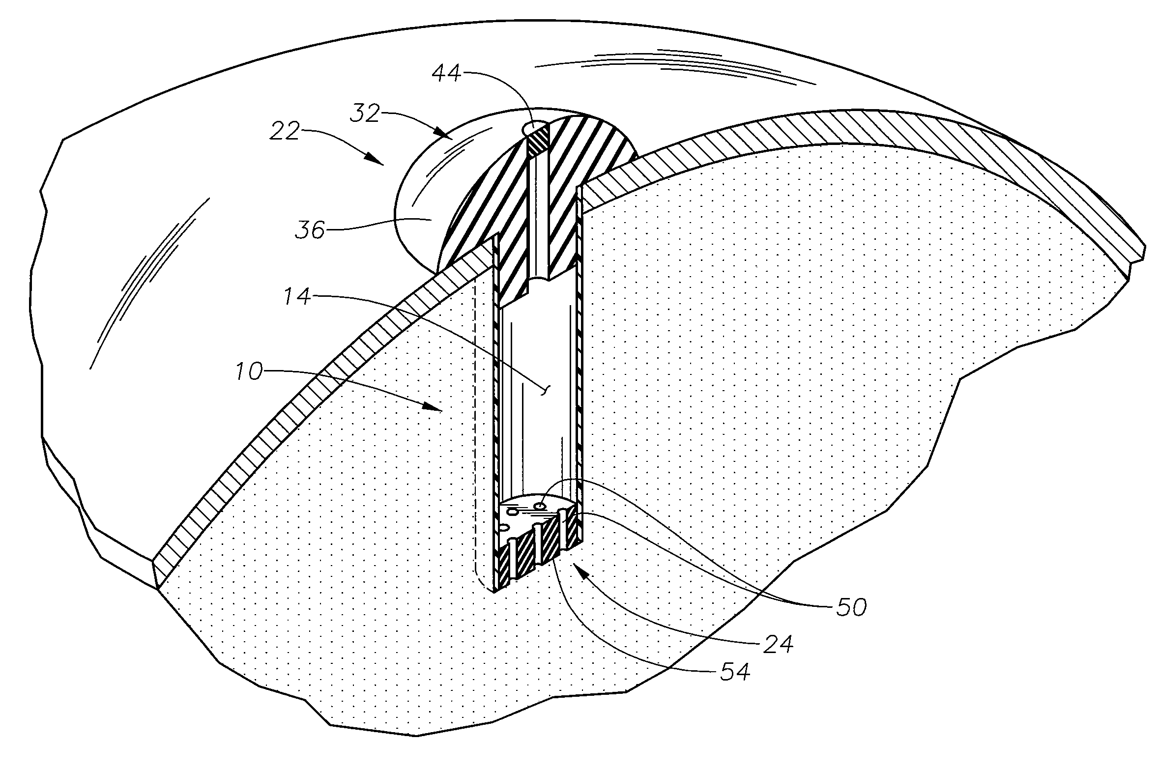 In-situ refillable ophthalmic implant