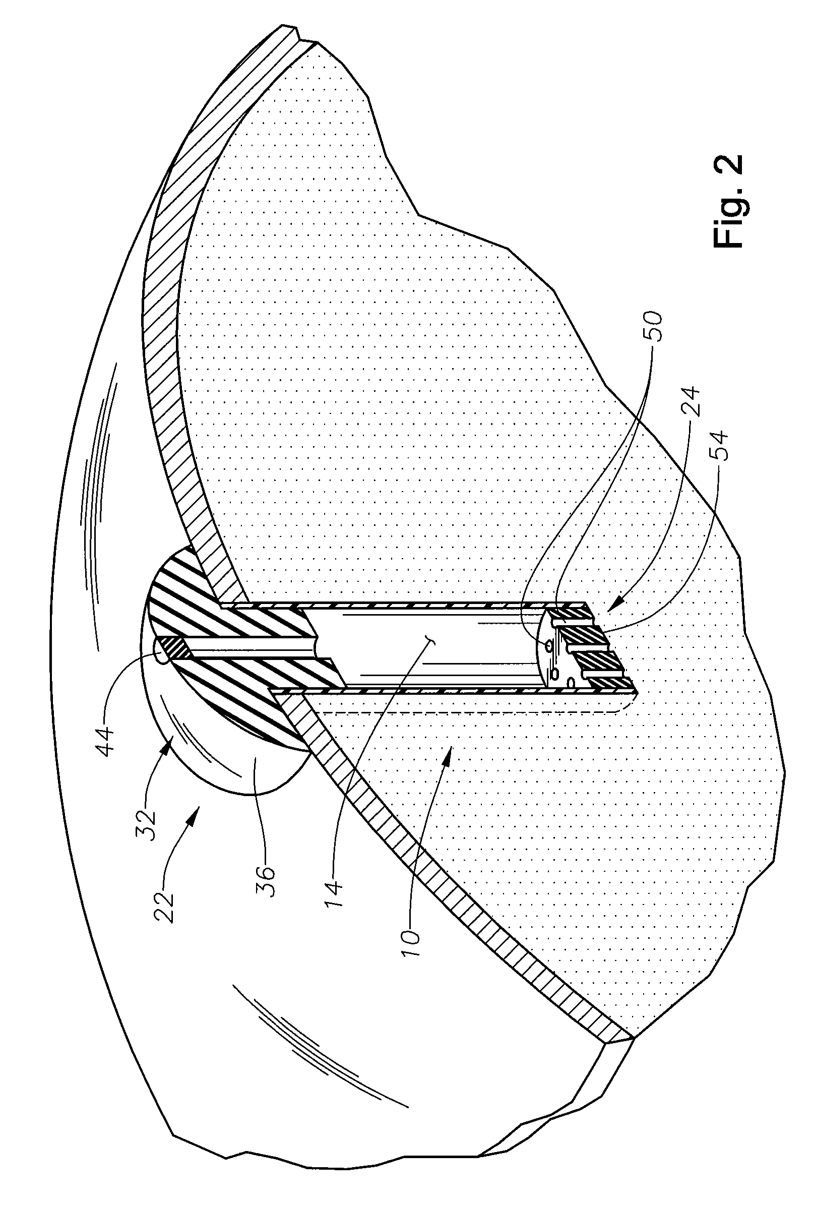 In-situ refillable ophthalmic implant