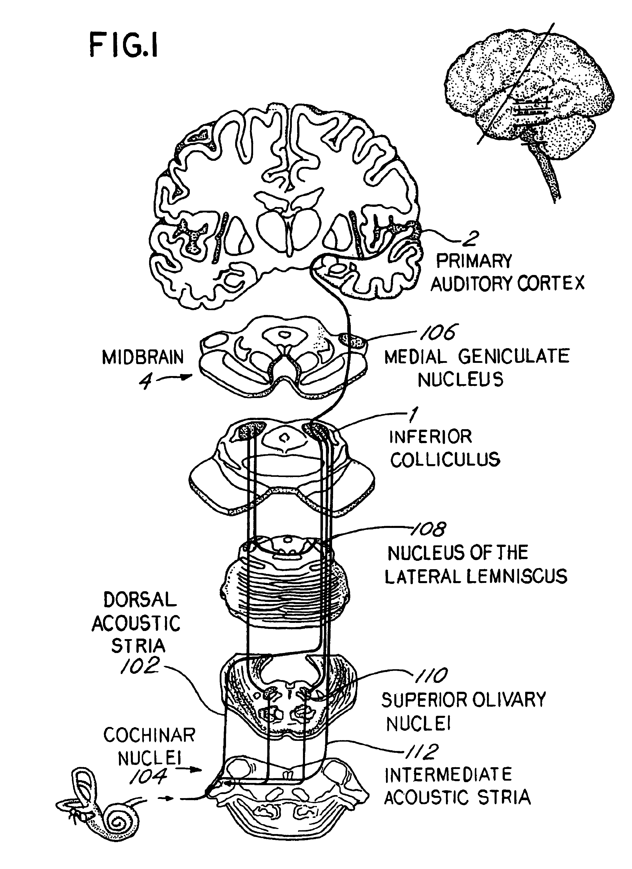 Method for treating severe tinnitus