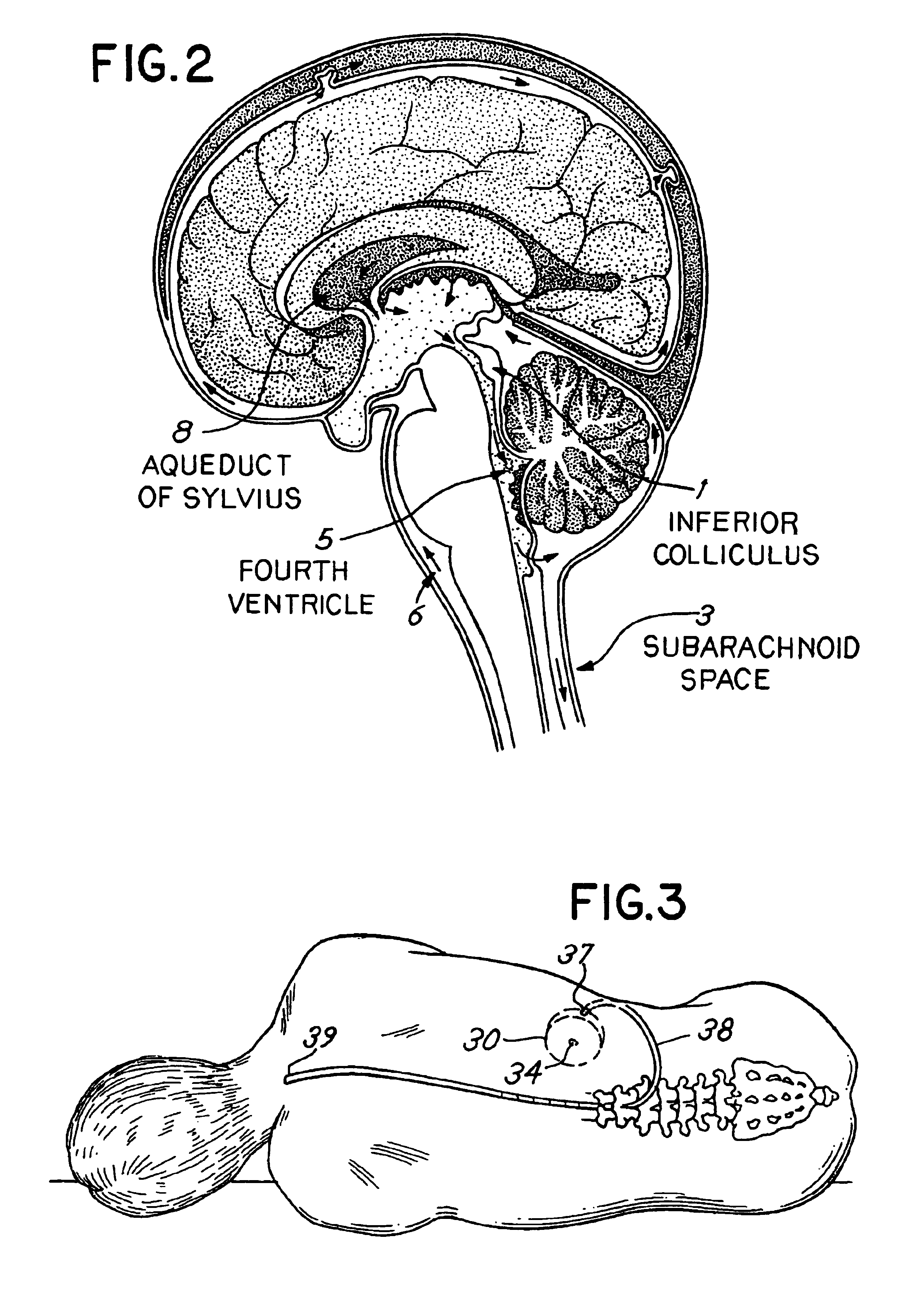 Method for treating severe tinnitus