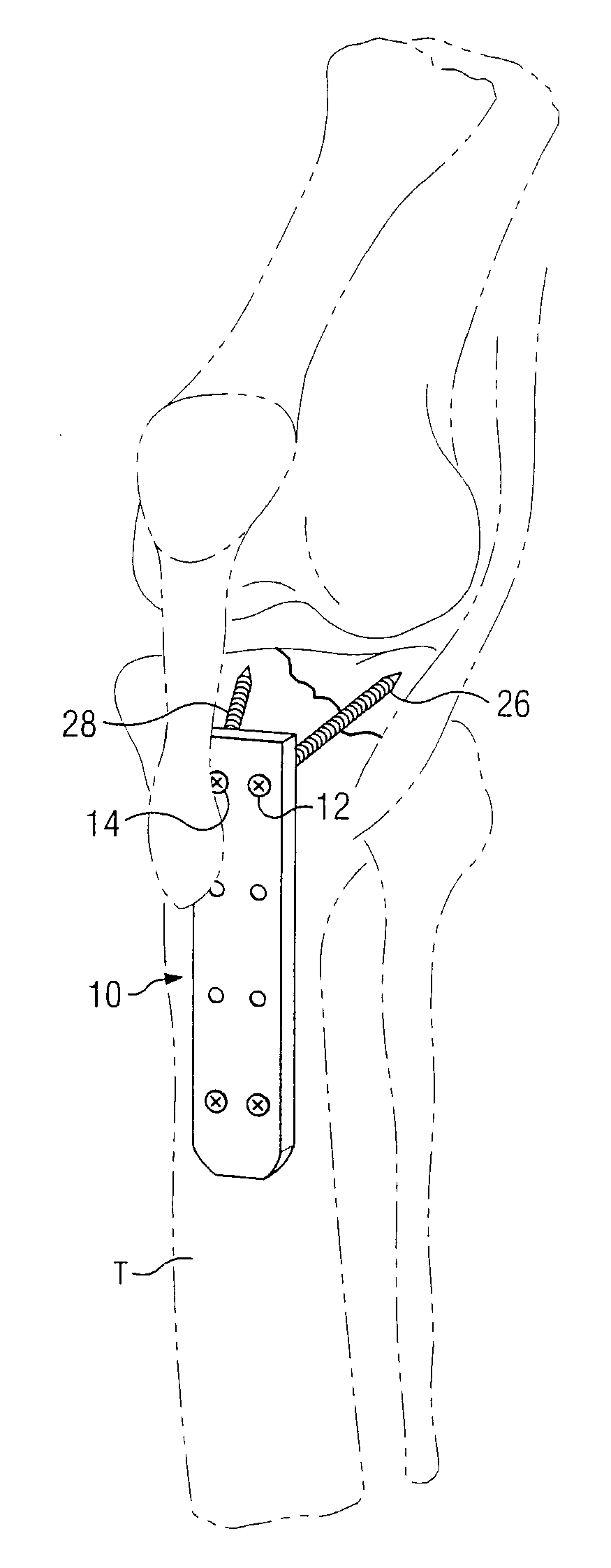 Percutaneous Fixator and Method of Insertion