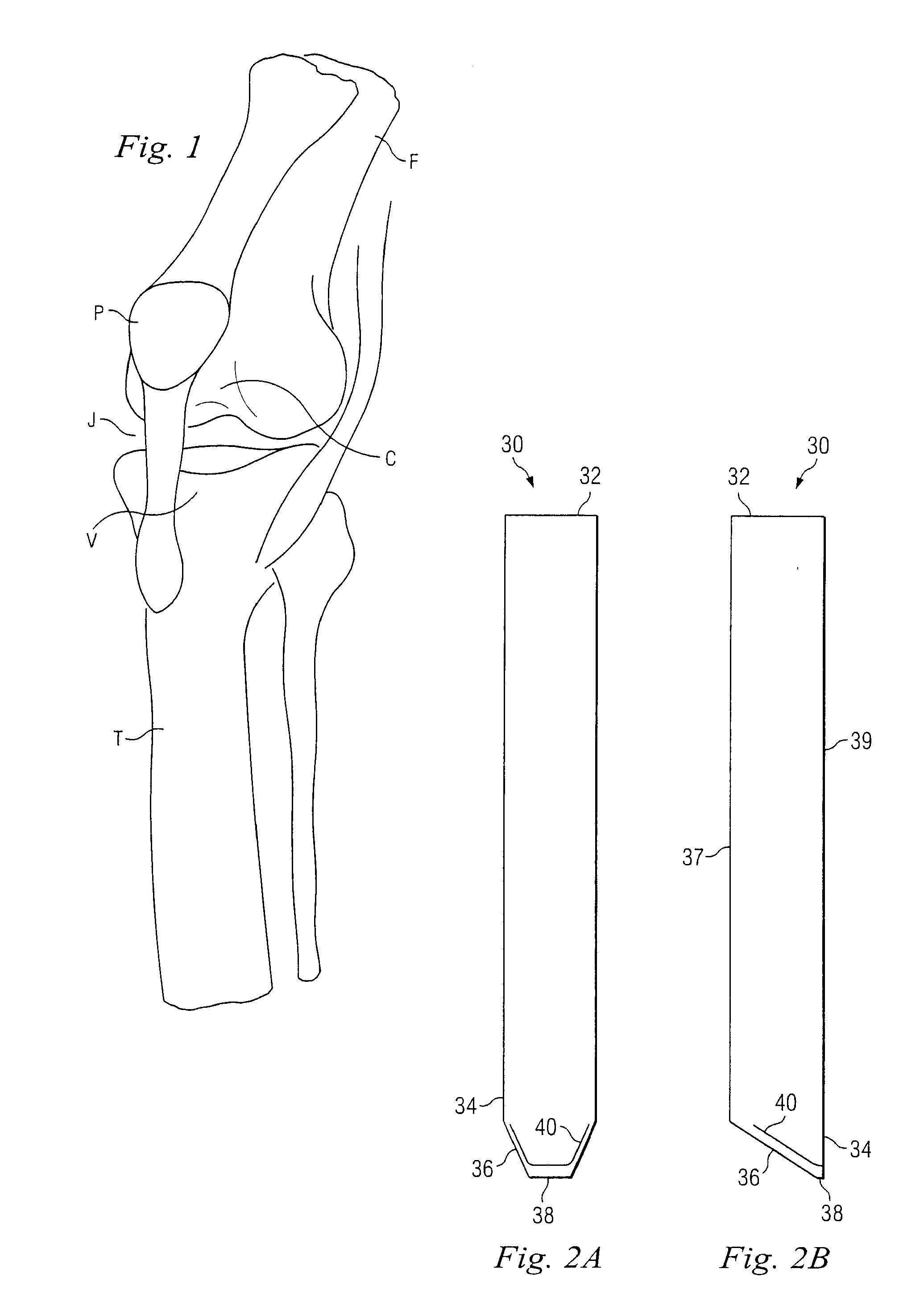 Percutaneous Fixator and Method of Insertion