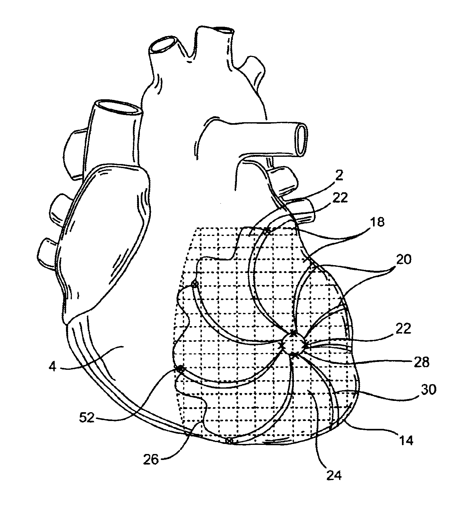 Heart support to prevent ventricular remodeling