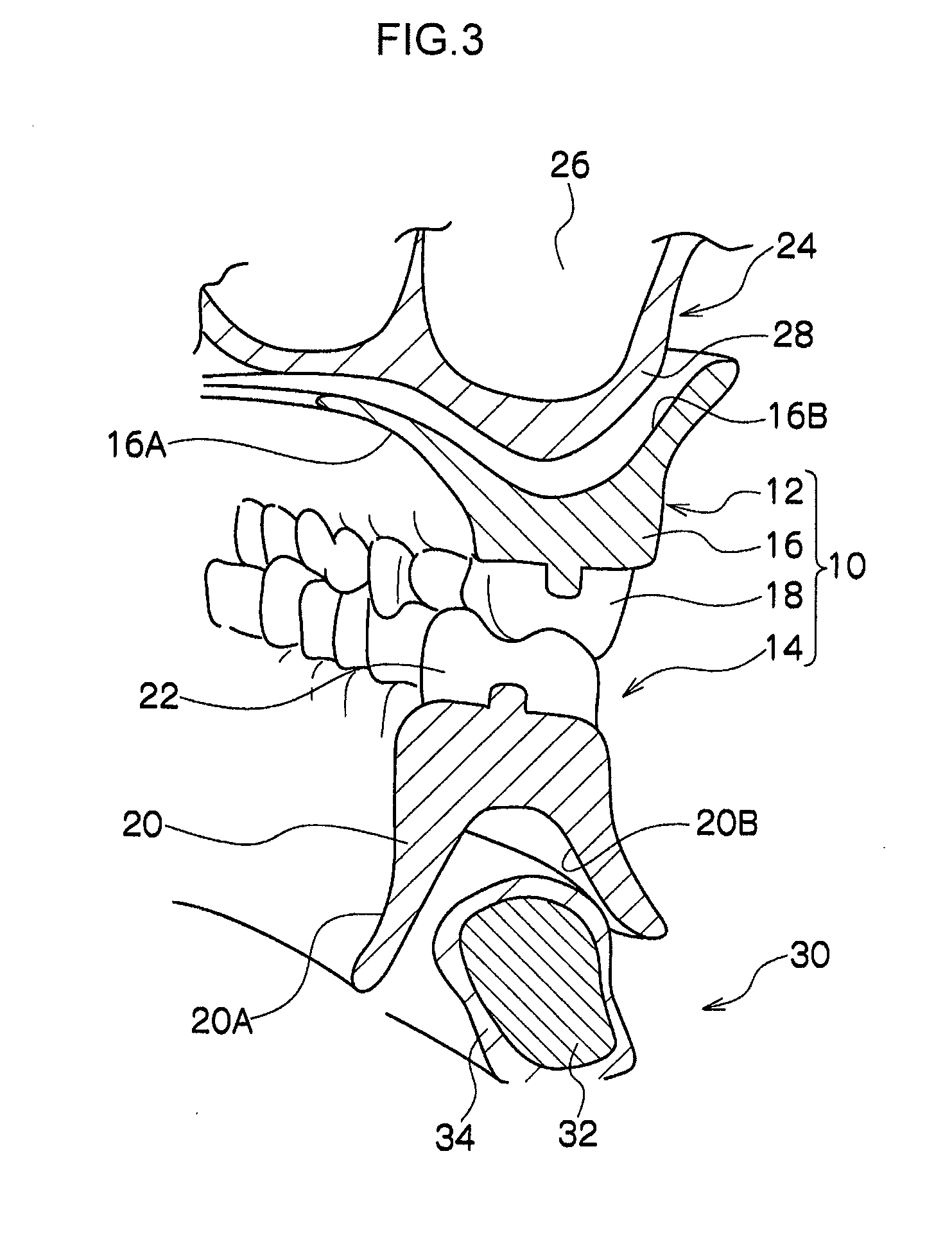 Removable denture and method of producing the same