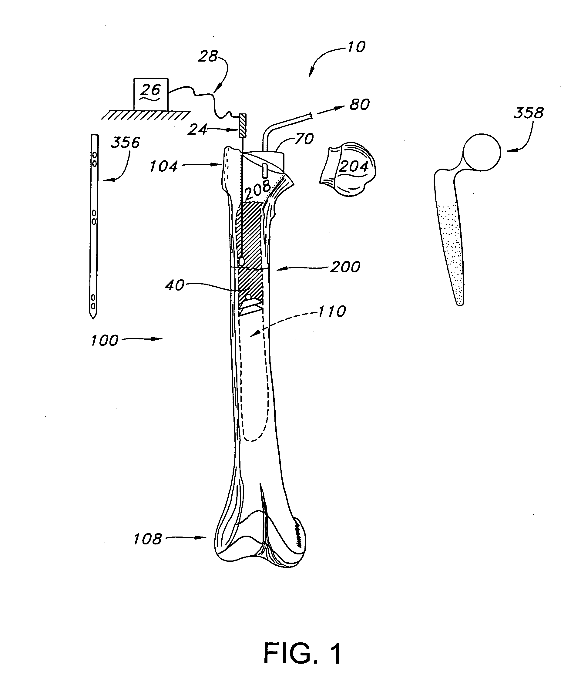 Method and apparatus for strengthening the biomechanical properties of implants