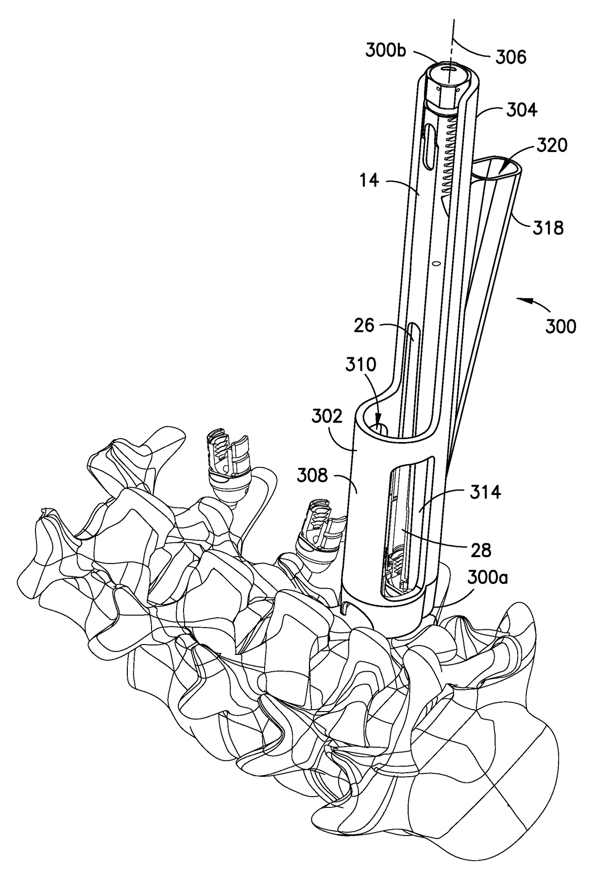 Minimally invasive posterolateral fusion