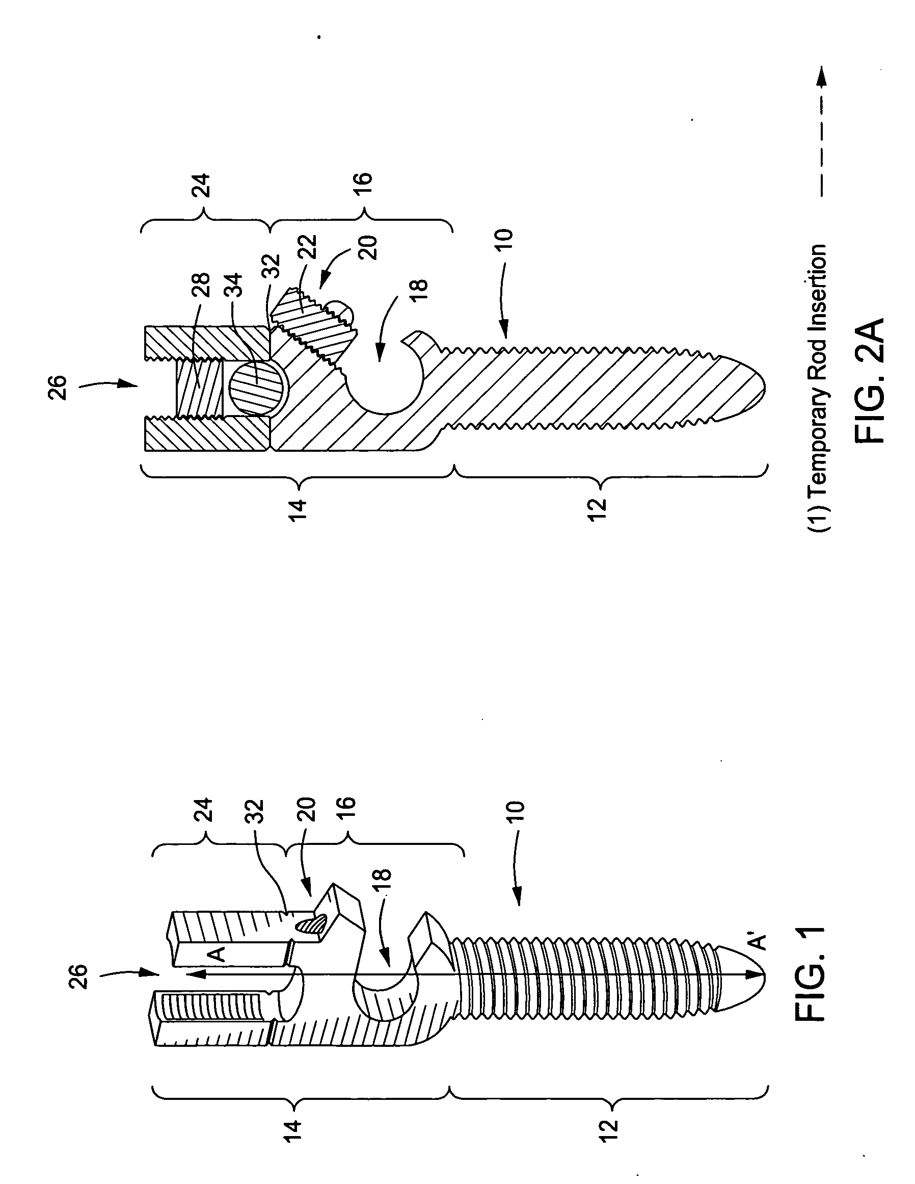 Pedicle Screw