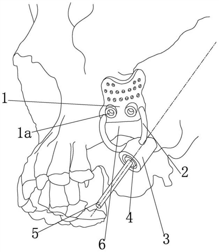 Bone support type upper jaw rear long implant implantation guide seat based on three-dimensional printing technology