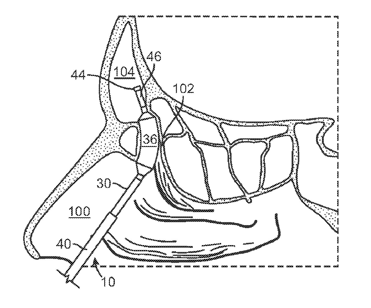 Method and articles for treating the sinus system