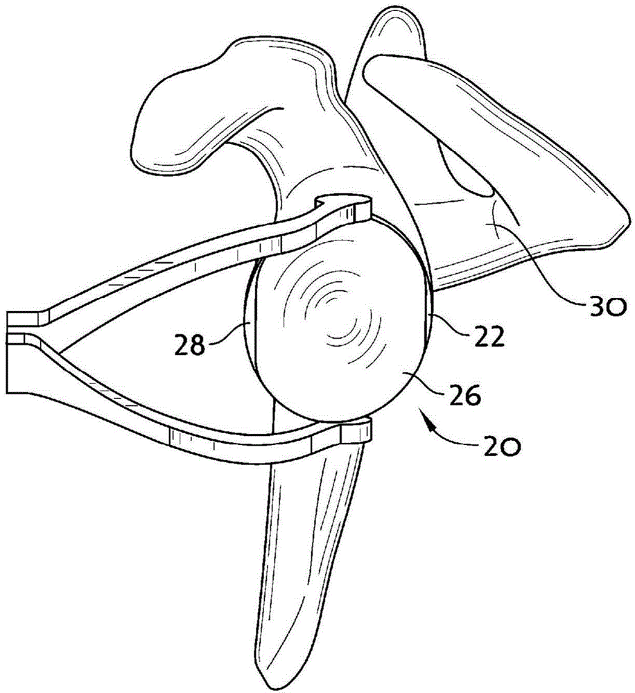 System And Method For Implanting A Secondary Glenoid Prosthesis