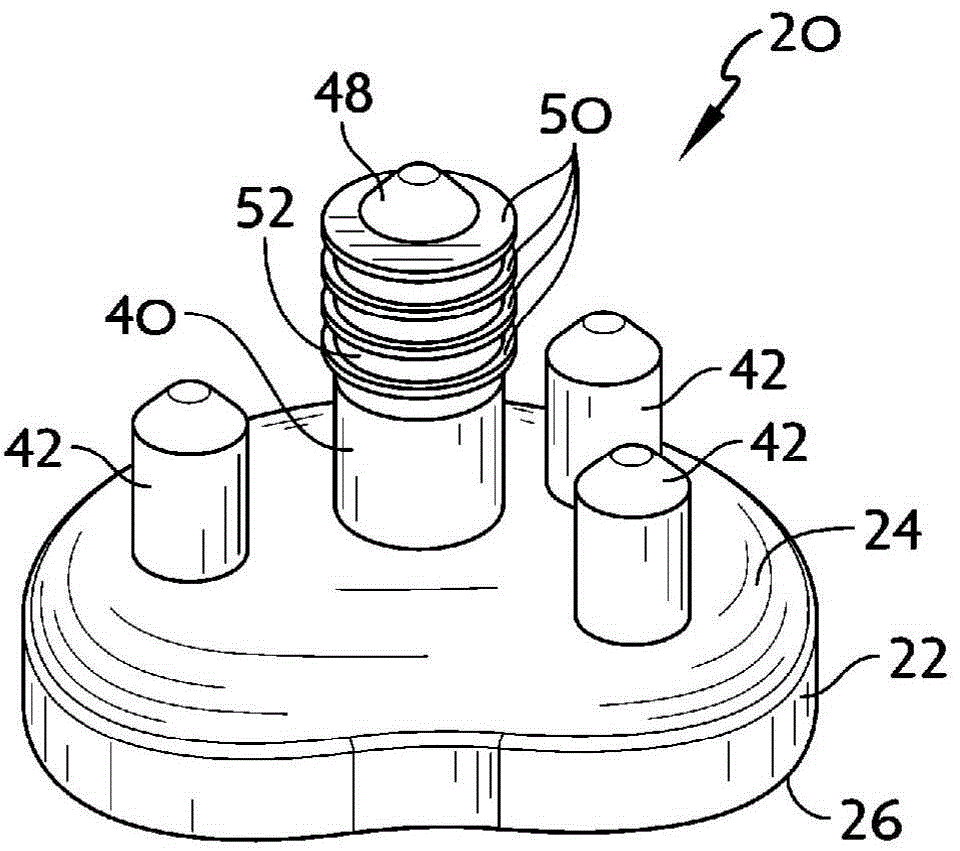 System And Method For Implanting A Secondary Glenoid Prosthesis