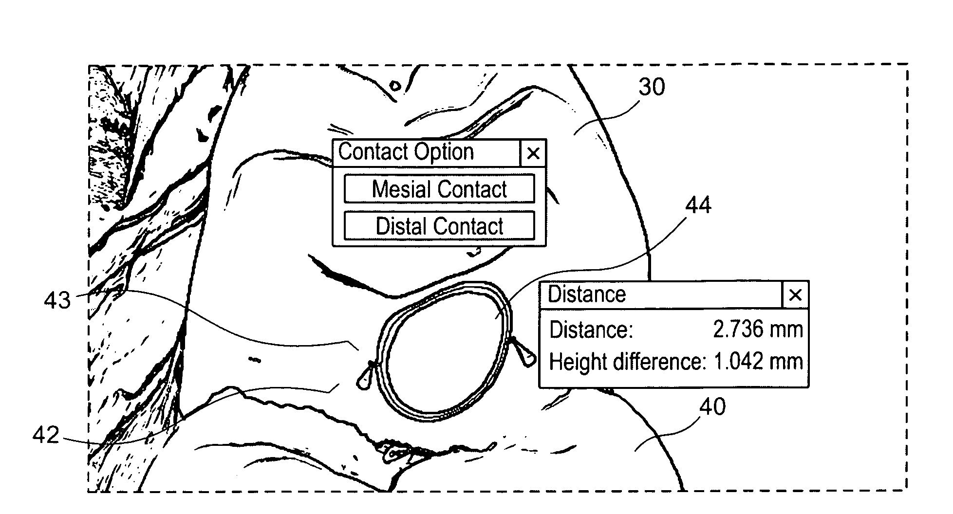 Method for designing a plurality of adjacent tooth restorations using CAD/CAM technology