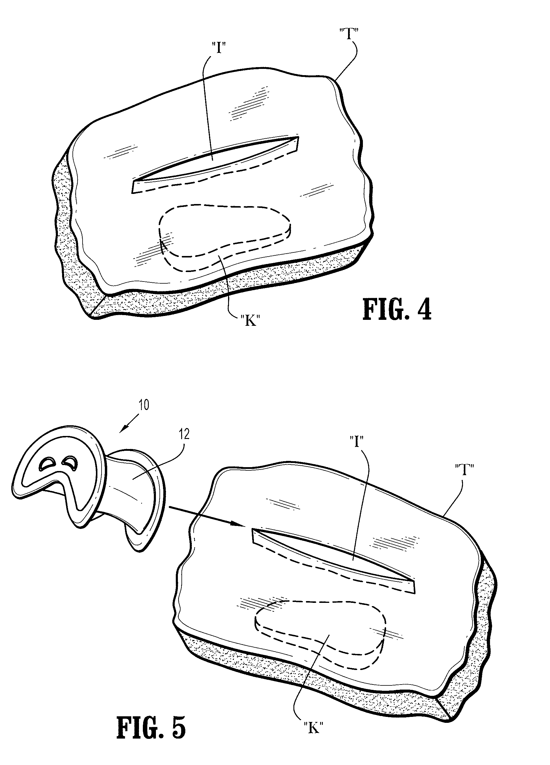 Flexible access assembly with reinforced lumen