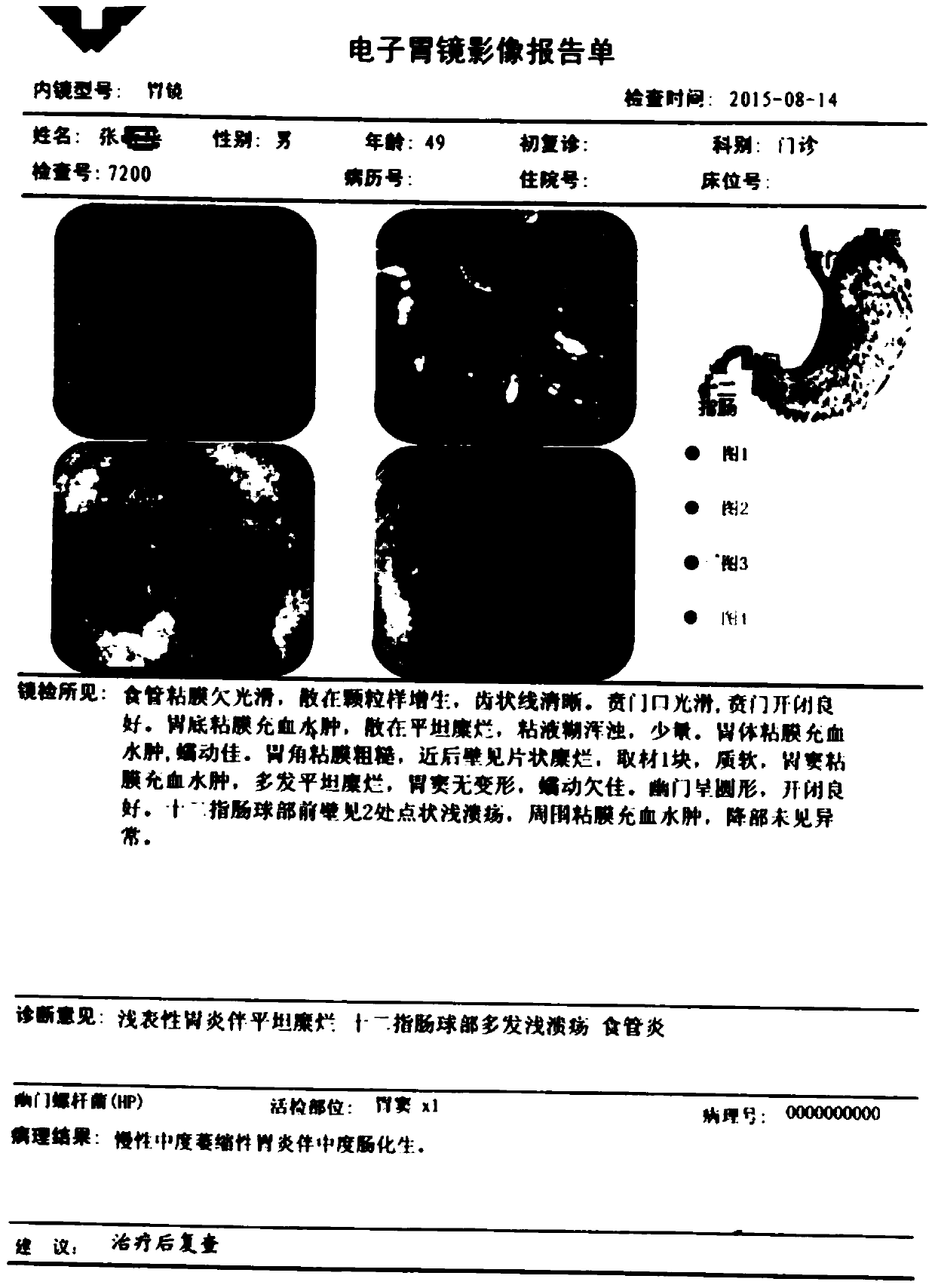 Traditional Chinese medicine compound composition for treating chronic atrophic gastritis and gastric precancerous lesions and application thereof