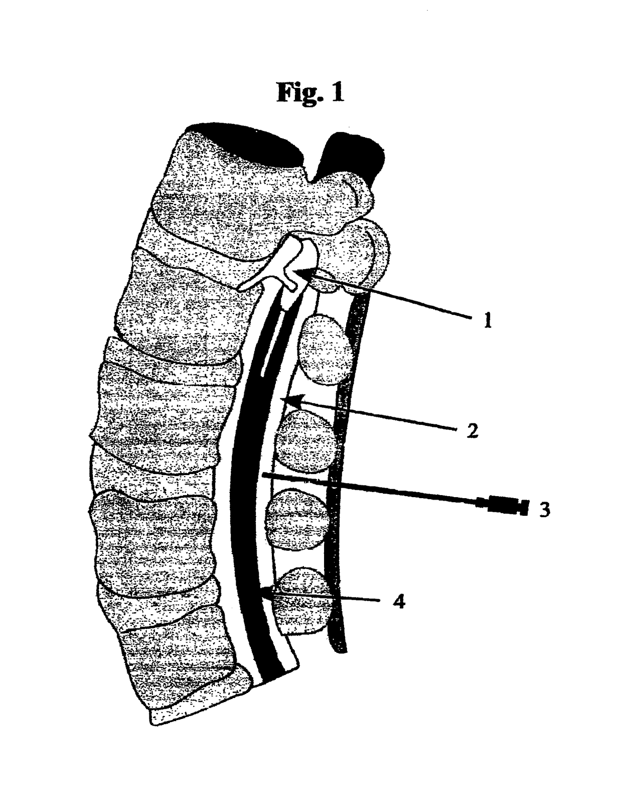 Citrate resorption of bone as a treatment for spinal stenosis