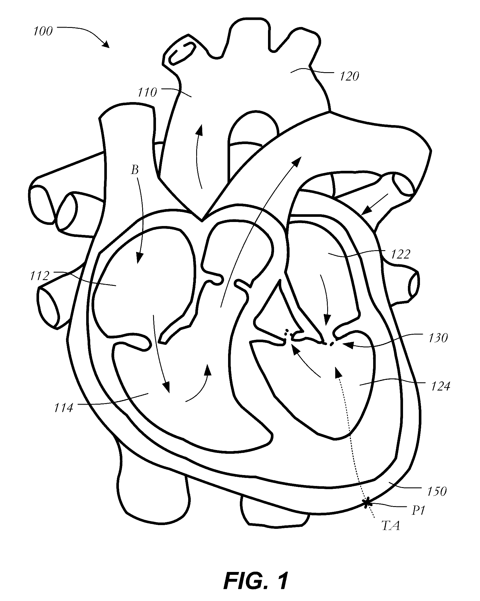 Mitral heart valve replacement