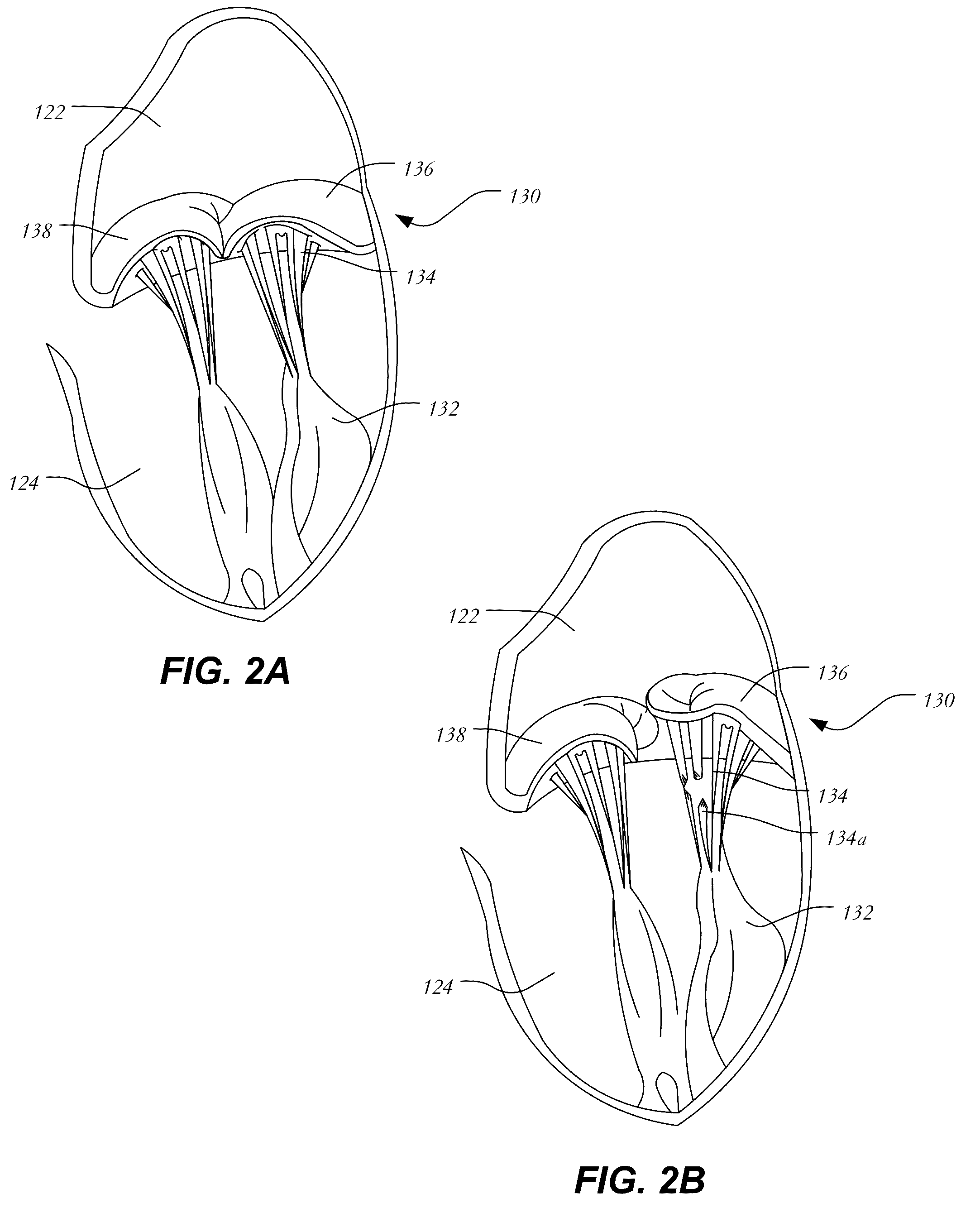 Mitral heart valve replacement