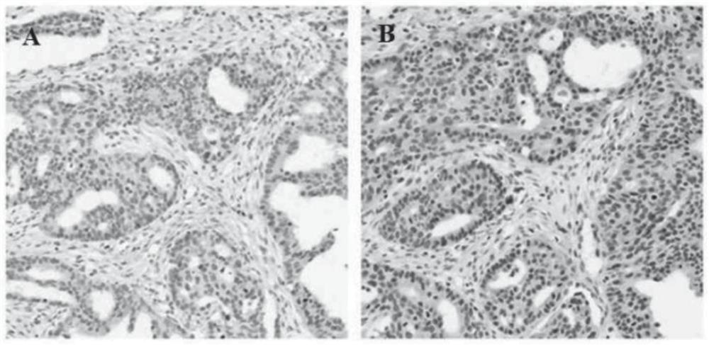 XAB2 protein as marker for prognosis and/or prediction of platinum drug resistance of ovarian cancer