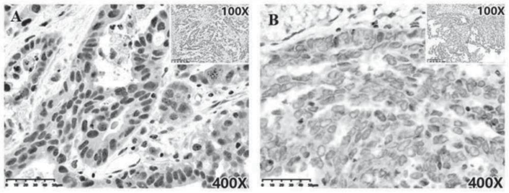 XAB2 protein as marker for prognosis and/or prediction of platinum drug resistance of ovarian cancer